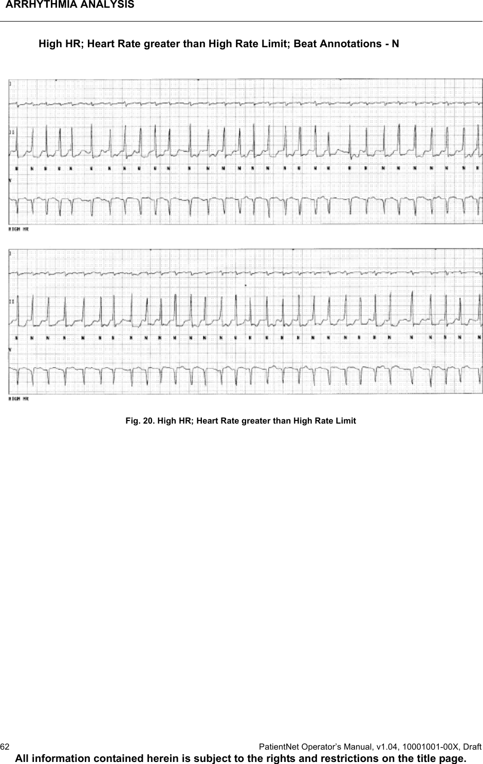 ARRHYTHMIA ANALYSIS62  PatientNet Operator’s Manual, v1.04, 10001001-00X, DraftAll information contained herein is subject to the rights and restrictions on the title page.High HR; Heart Rate greater than High Rate Limit; Beat Annotations - NFig. 20. High HR; Heart Rate greater than High Rate Limit