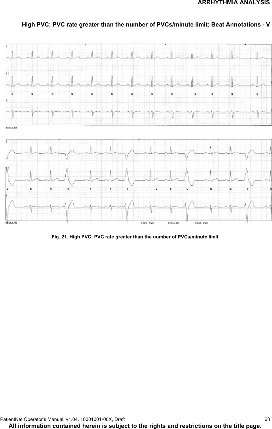 ARRHYTHMIA ANALYSISPatientNet Operator’s Manual, v1.04, 10001001-00X, Draft   63All information contained herein is subject to the rights and restrictions on the title page.High PVC; PVC rate greater than the number of PVCs/minute limit; Beat Annotations - VFig. 21. High PVC; PVC rate greater than the number of PVCs/minute limit