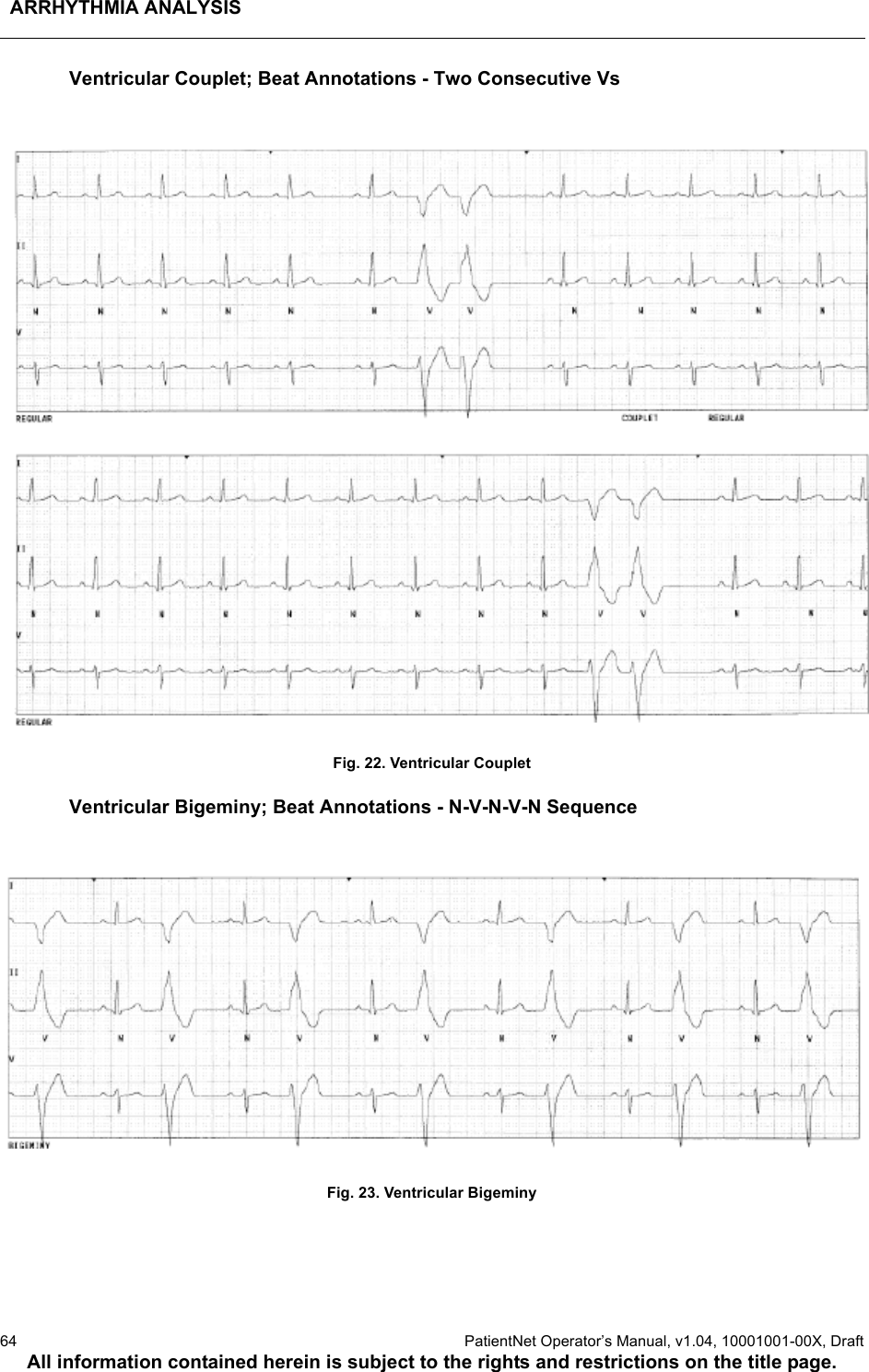 ARRHYTHMIA ANALYSIS64  PatientNet Operator’s Manual, v1.04, 10001001-00X, DraftAll information contained herein is subject to the rights and restrictions on the title page.Ventricular Couplet; Beat Annotations - Two Consecutive VsFig. 22. Ventricular CoupletVentricular Bigeminy; Beat Annotations - N-V-N-V-N SequenceFig. 23. Ventricular Bigeminy