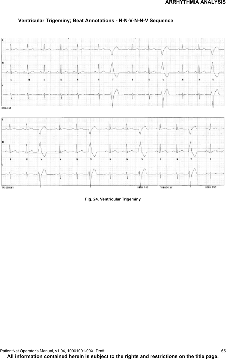 ARRHYTHMIA ANALYSISPatientNet Operator’s Manual, v1.04, 10001001-00X, Draft   65All information contained herein is subject to the rights and restrictions on the title page.Ventricular Trigeminy; Beat Annotations - N-N-V-N-N-V SequenceFig. 24. Ventricular Trigeminy