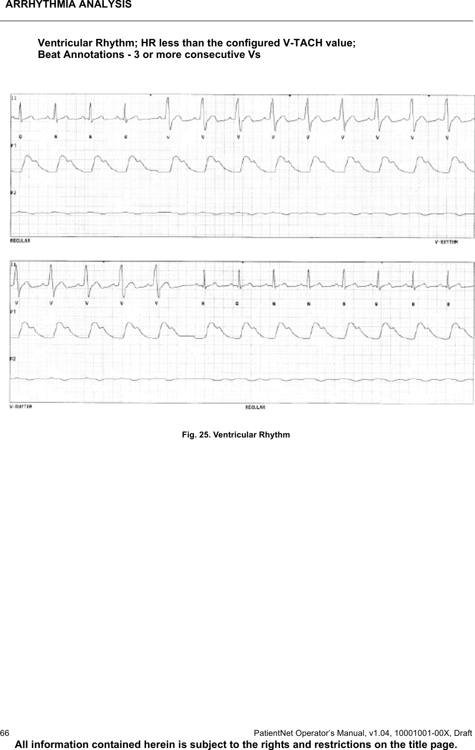 ARRHYTHMIA ANALYSIS66  PatientNet Operator’s Manual, v1.04, 10001001-00X, DraftAll information contained herein is subject to the rights and restrictions on the title page.Ventricular Rhythm; HR less than the configured V-TACH value;Beat Annotations - 3 or more consecutive VsFig. 25. Ventricular Rhythm