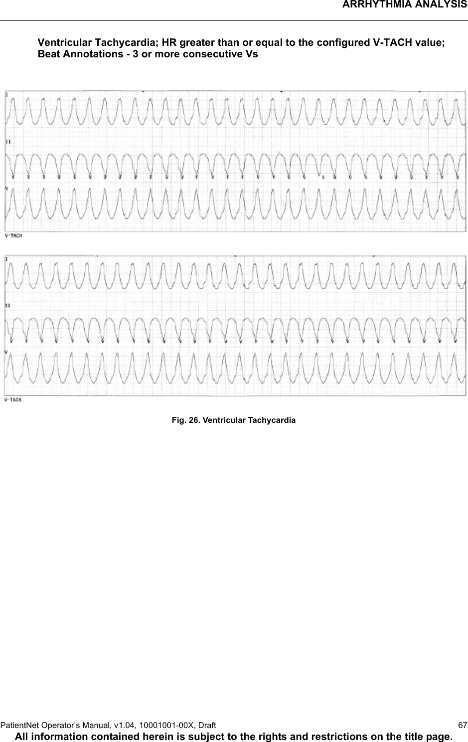 ARRHYTHMIA ANALYSISPatientNet Operator’s Manual, v1.04, 10001001-00X, Draft   67All information contained herein is subject to the rights and restrictions on the title page.Ventricular Tachycardia; HR greater than or equal to the configured V-TACH value;Beat Annotations - 3 or more consecutive VsFig. 26. Ventricular Tachycardia