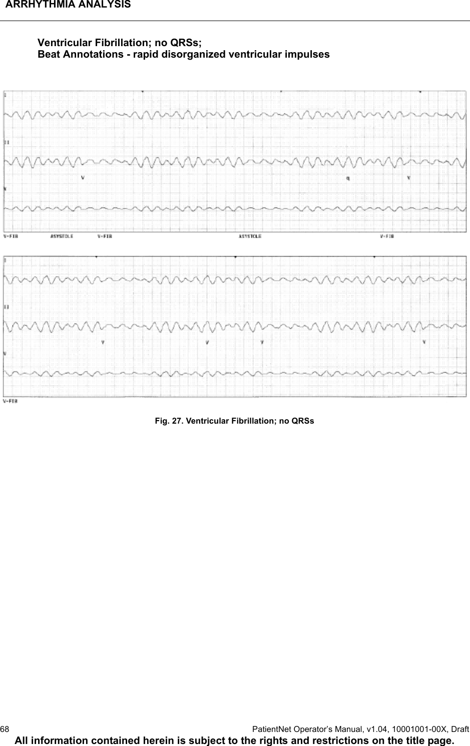 ARRHYTHMIA ANALYSIS68  PatientNet Operator’s Manual, v1.04, 10001001-00X, DraftAll information contained herein is subject to the rights and restrictions on the title page.Ventricular Fibrillation; no QRSs; Beat Annotations - rapid disorganized ventricular impulsesFig. 27. Ventricular Fibrillation; no QRSs