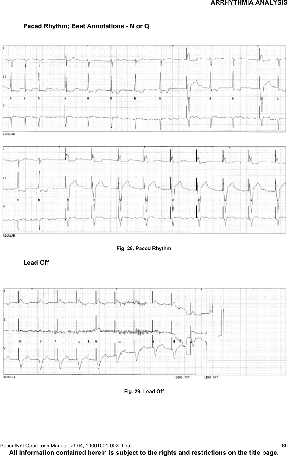 ARRHYTHMIA ANALYSISPatientNet Operator’s Manual, v1.04, 10001001-00X, Draft   69All information contained herein is subject to the rights and restrictions on the title page.Paced Rhythm; Beat Annotations - N or QFig. 28. Paced RhythmLead OffFig. 29. Lead Off