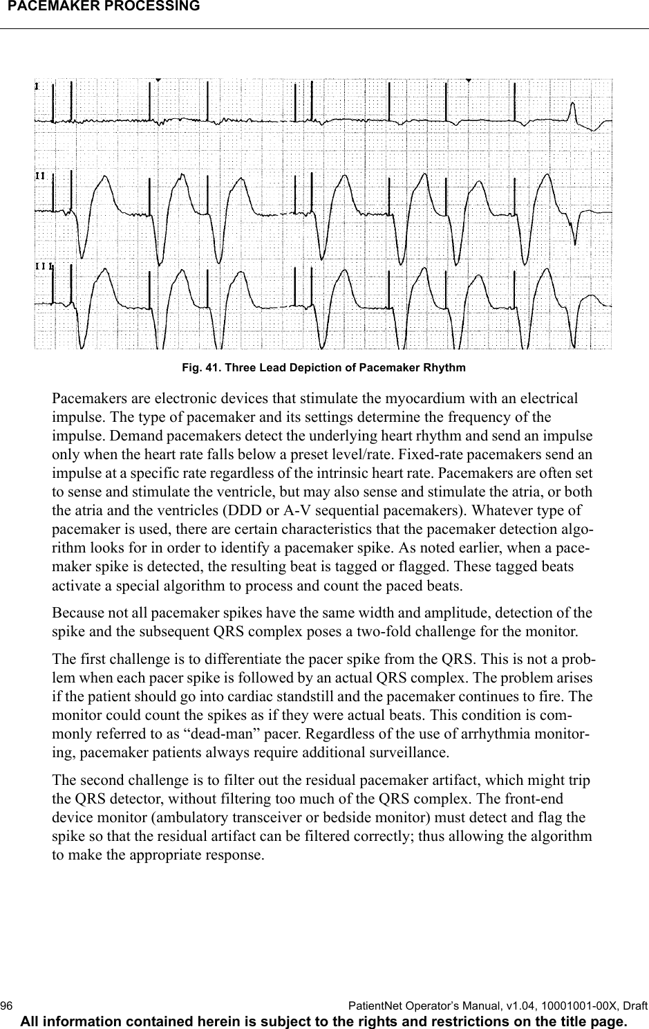 PACEMAKER PROCESSING96  PatientNet Operator’s Manual, v1.04, 10001001-00X, DraftAll information contained herein is subject to the rights and restrictions on the title page. Fig. 41. Three Lead Depiction of Pacemaker RhythmPacemakers are electronic devices that stimulate the myocardium with an electrical impulse. The type of pacemaker and its settings determine the frequency of the impulse. Demand pacemakers detect the underlying heart rhythm and send an impulse only when the heart rate falls below a preset level/rate. Fixed-rate pacemakers send an impulse at a specific rate regardless of the intrinsic heart rate. Pacemakers are often set to sense and stimulate the ventricle, but may also sense and stimulate the atria, or both the atria and the ventricles (DDD or A-V sequential pacemakers). Whatever type of pacemaker is used, there are certain characteristics that the pacemaker detection algo-rithm looks for in order to identify a pacemaker spike. As noted earlier, when a pace-maker spike is detected, the resulting beat is tagged or flagged. These tagged beats activate a special algorithm to process and count the paced beats.Because not all pacemaker spikes have the same width and amplitude, detection of the spike and the subsequent QRS complex poses a two-fold challenge for the monitor.The first challenge is to differentiate the pacer spike from the QRS. This is not a prob-lem when each pacer spike is followed by an actual QRS complex. The problem arises if the patient should go into cardiac standstill and the pacemaker continues to fire. The monitor could count the spikes as if they were actual beats. This condition is com-monly referred to as “dead-man” pacer. Regardless of the use of arrhythmia monitor-ing, pacemaker patients always require additional surveillance.The second challenge is to filter out the residual pacemaker artifact, which might trip the QRS detector, without filtering too much of the QRS complex. The front-end device monitor (ambulatory transceiver or bedside monitor) must detect and flag the spike so that the residual artifact can be filtered correctly; thus allowing the algorithm to make the appropriate response.