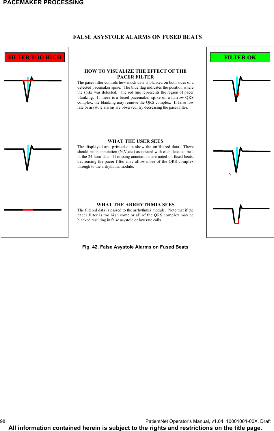 PACEMAKER PROCESSING98  PatientNet Operator’s Manual, v1.04, 10001001-00X, DraftAll information contained herein is subject to the rights and restrictions on the title page.Fig. 42. False Asystole Alarms on Fused BeatsHOW TO VISUALIZE THE EFFECT OF THEPACER FILTERThe pacer filter controls how much data is blanked on both sides of adetected pacemaker spike.  The blue flag indicates the position wherethe spike was detected.  The red line represents the region of pacerblanking.  If there is a fused pacemaker spike on a narrow QRScomplex, the blanking may remove the QRS complex.  If false lowrate or asystole alarms are observed, try decreasing the pacer filter.WHAT THE USER SEESThe displayed and printed data show the unfiltered data.  Thereshould be an annotation (N,V,etc.) associated with each detected beatin the 24 hour data.  If missing annotations are noted on fused beats,decreasing the pacer filter may allow more of the QRS complexthrough to the arrhythmia module.FILTER TOO HIGH FILTER OKNFALSE ASYSTOLE ALARMS ON FUSED BEATSWHAT THE ARRHYTHMIA SEESThe filtered data is passed to the arrhythmia module.  Note that if thepacer filter is too high some or all of the QRS complex may beblanked resulting in false asystole or low rate calls.