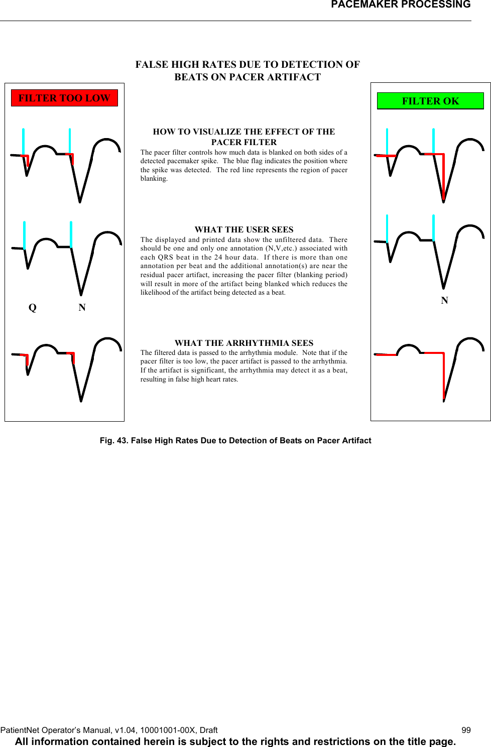 PACEMAKER PROCESSINGPatientNet Operator’s Manual, v1.04, 10001001-00X, Draft   99All information contained herein is subject to the rights and restrictions on the title page.Fig. 43. False High Rates Due to Detection of Beats on Pacer ArtifactHOW TO VISUALIZE THE EFFECT OF THEPACER FILTERThe pacer filter controls how much data is blanked on both sides of adetected pacemaker spike.  The blue flag indicates the position wherethe spike was detected.  The red line represents the region of pacerblanking.WHAT THE USER SEESThe displayed and printed data show the unfiltered data.  Thereshould be one and only one annotation (N,V,etc.) associated witheach QRS beat in the 24 hour data.  If there is more than oneannotation per beat and the additional annotation(s) are near theresidual pacer artifact, increasing the pacer filter (blanking period)will result in more of the artifact being blanked which reduces thelikelihood of the artifact being detected as a beat.FILTER TOO LOW FILTER OKFALSE HIGH RATES DUE TO DETECTION OFBEATS ON PACER ARTIFACTWHAT THE ARRHYTHMIA SEESThe filtered data is passed to the arrhythmia module.  Note that if thepacer filter is too low, the pacer artifact is passed to the arrhythmia.If the artifact is significant, the arrhythmia may detect it as a beat,resulting in false high heart rates.Q N N