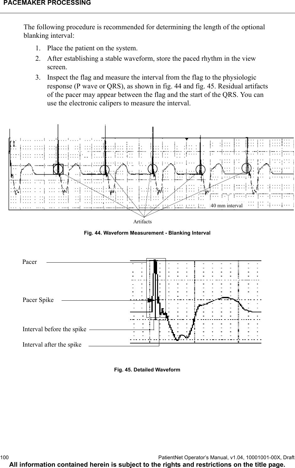 PACEMAKER PROCESSING100  PatientNet Operator’s Manual, v1.04, 10001001-00X, DraftAll information contained herein is subject to the rights and restrictions on the title page.The following procedure is recommended for determining the length of the optional blanking interval:1. Place the patient on the system.2. After establishing a stable waveform, store the paced rhythm in the view screen.3. Inspect the flag and measure the interval from the flag to the physiologic response (P wave or QRS), as shown in fig. 44 and fig. 45. Residual artifacts of the pacer may appear between the flag and the start of the QRS. You can use the electronic calipers to measure the interval.Fig. 44. Waveform Measurement - Blanking IntervalFig. 45. Detailed Waveform40 mm intervalArtifactsPacerPacer SpikeInterval before the spikeInterval after the spike