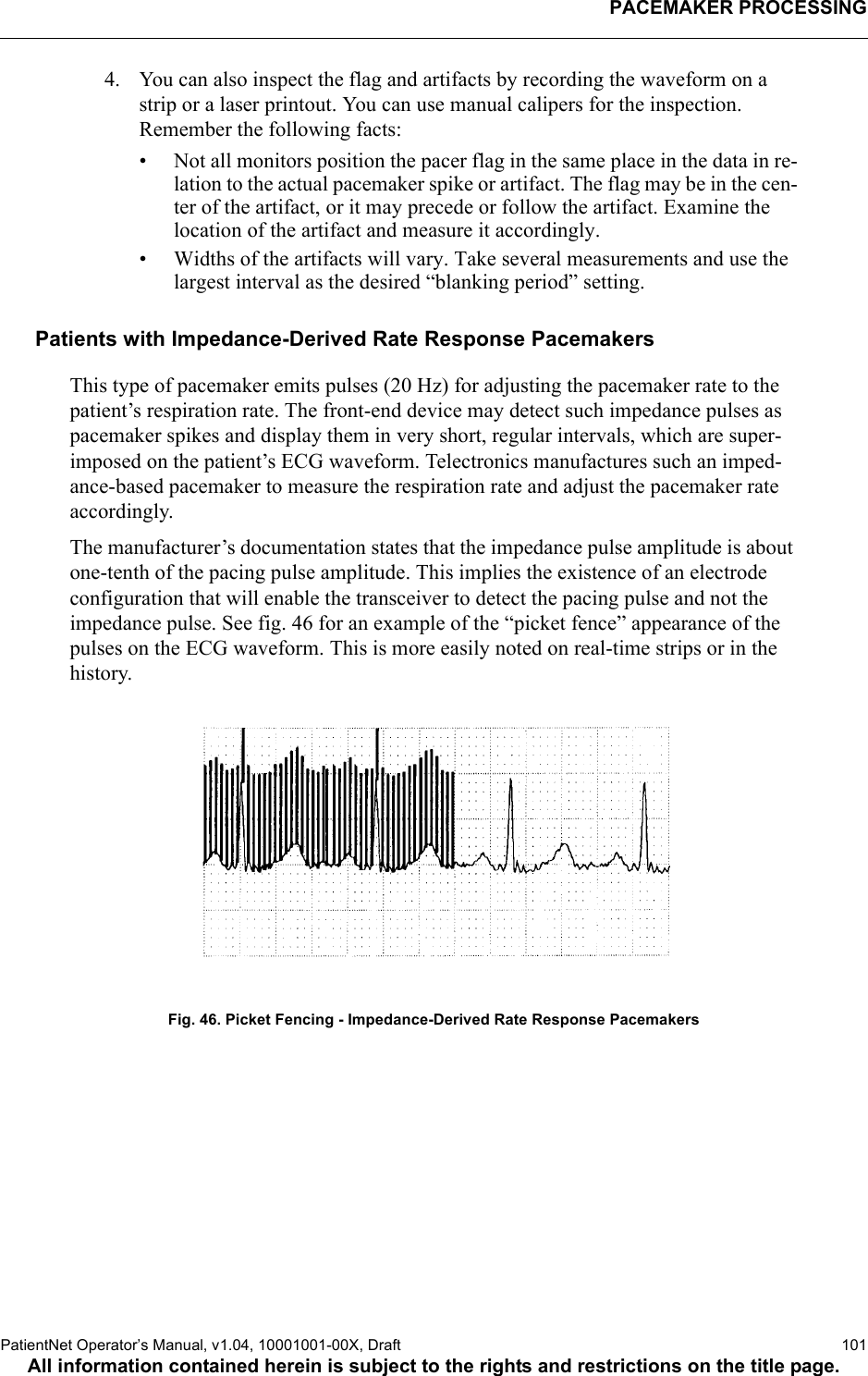 PACEMAKER PROCESSINGPatientNet Operator’s Manual, v1.04, 10001001-00X, Draft   101All information contained herein is subject to the rights and restrictions on the title page.4. You can also inspect the flag and artifacts by recording the waveform on a strip or a laser printout. You can use manual calipers for the inspection. Remember the following facts:• Not all monitors position the pacer flag in the same place in the data in re-lation to the actual pacemaker spike or artifact. The flag may be in the cen-ter of the artifact, or it may precede or follow the artifact. Examine the location of the artifact and measure it accordingly.• Widths of the artifacts will vary. Take several measurements and use the largest interval as the desired “blanking period” setting.Patients with Impedance-Derived Rate Response PacemakersThis type of pacemaker emits pulses (20 Hz) for adjusting the pacemaker rate to the patient’s respiration rate. The front-end device may detect such impedance pulses as pacemaker spikes and display them in very short, regular intervals, which are super-imposed on the patient’s ECG waveform. Telectronics manufactures such an imped-ance-based pacemaker to measure the respiration rate and adjust the pacemaker rate accordingly.The manufacturer’s documentation states that the impedance pulse amplitude is about one-tenth of the pacing pulse amplitude. This implies the existence of an electrode configuration that will enable the transceiver to detect the pacing pulse and not the impedance pulse. See fig. 46 for an example of the “picket fence” appearance of the pulses on the ECG waveform. This is more easily noted on real-time strips or in the history.Fig. 46. Picket Fencing - Impedance-Derived Rate Response Pacemakers