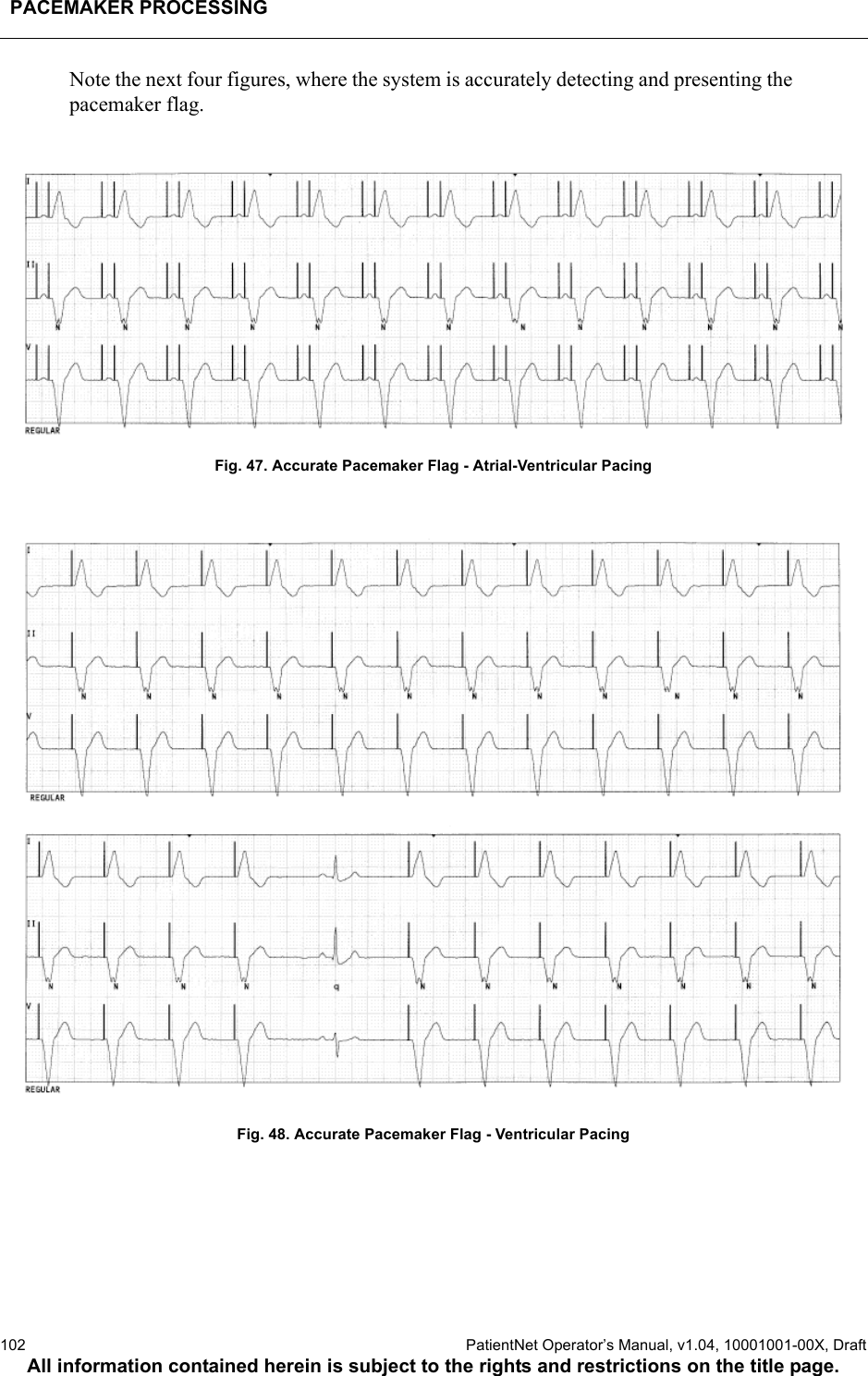 PACEMAKER PROCESSING102  PatientNet Operator’s Manual, v1.04, 10001001-00X, DraftAll information contained herein is subject to the rights and restrictions on the title page.Note the next four figures, where the system is accurately detecting and presenting the pacemaker flag.Fig. 47. Accurate Pacemaker Flag - Atrial-Ventricular PacingFig. 48. Accurate Pacemaker Flag - Ventricular Pacing