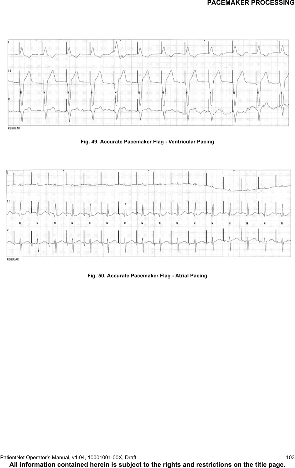 PACEMAKER PROCESSINGPatientNet Operator’s Manual, v1.04, 10001001-00X, Draft   103All information contained herein is subject to the rights and restrictions on the title page.Fig. 49. Accurate Pacemaker Flag - Ventricular PacingFig. 50. Accurate Pacemaker Flag - Atrial Pacing