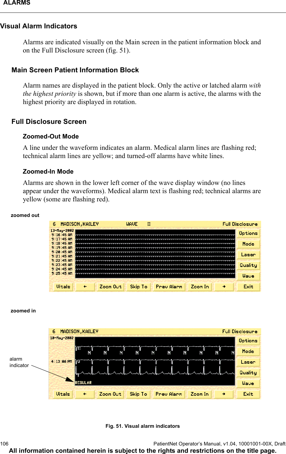 ALARMS106  PatientNet Operator’s Manual, v1.04, 10001001-00X, DraftAll information contained herein is subject to the rights and restrictions on the title page.Visual Alarm IndicatorsAlarms are indicated visually on the Main screen in the patient information block and on the Full Disclosure screen (fig. 51).Main Screen Patient Information BlockAlarm names are displayed in the patient block. Only the active or latched alarm with the highest priority is shown, but if more than one alarm is active, the alarms with the highest priority are displayed in rotation.Full Disclosure ScreenZoomed-Out ModeA line under the waveform indicates an alarm. Medical alarm lines are flashing red; technical alarm lines are yellow; and turned-off alarms have white lines.Zoomed-In ModeAlarms are shown in the lower left corner of the wave display window (no lines appear under the waveforms). Medical alarm text is flashing red; technical alarms are yellow (some are flashing red). Fig. 51. Visual alarm indicatorszoomed inalarmindicatorzoomed out