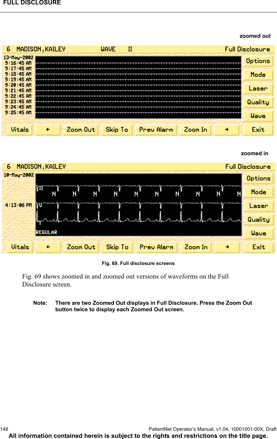 FULL DISCLOSURE148  PatientNet Operator’s Manual, v1.04, 10001001-00X, DraftAll information contained herein is subject to the rights and restrictions on the title page.Fig. 69. Full disclosure screensFig. 69 shows zoomed in and zoomed out versions of waveforms on the FullDisclosure screen.Note: There are two Zoomed Out displays in Full Disclosure. Press the Zoom Out button twice to display each Zoomed Out screen.zoomed outzoomed in