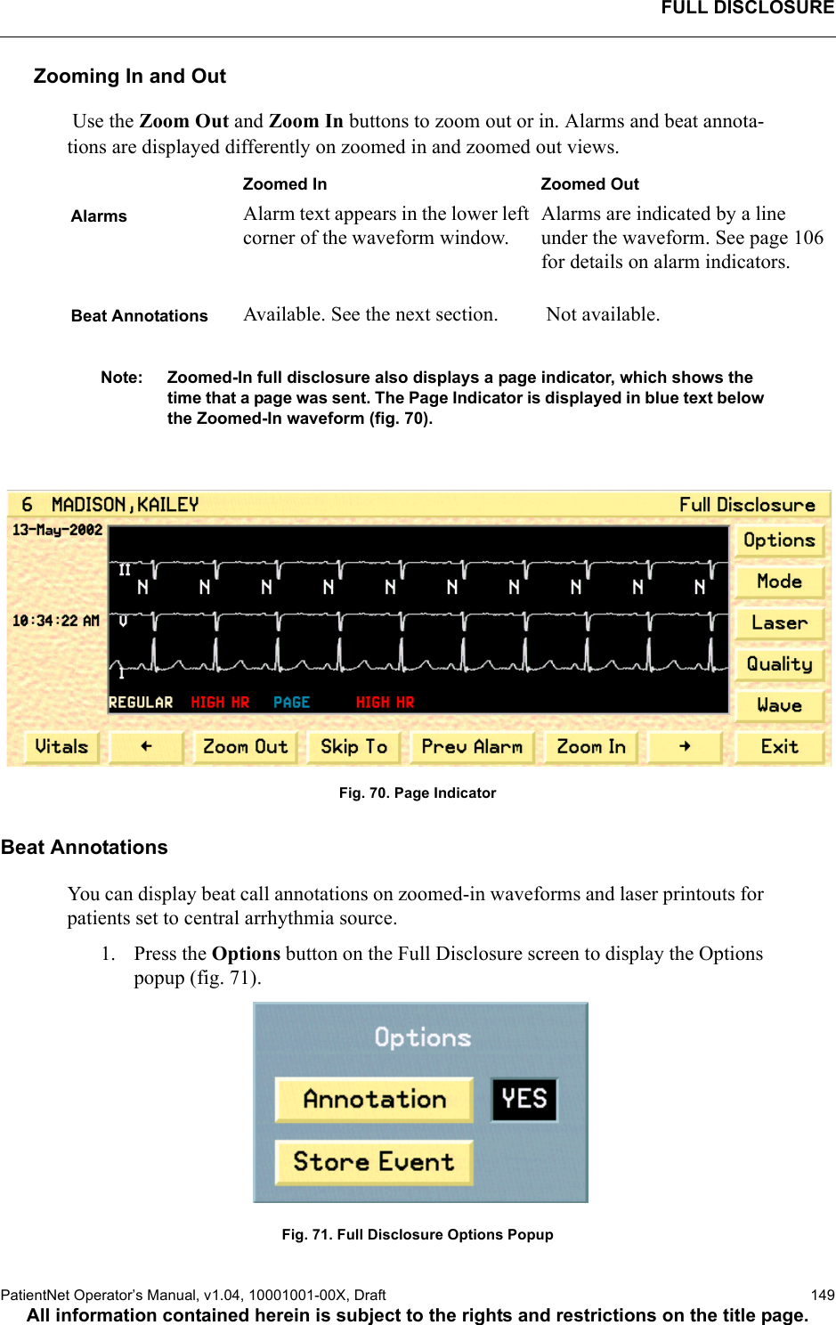 FULL DISCLOSUREPatientNet Operator’s Manual, v1.04, 10001001-00X, Draft    149All information contained herein is subject to the rights and restrictions on the title page.Zooming In and Out Use the Zoom Out and Zoom In buttons to zoom out or in. Alarms and beat annota-tions are displayed differently on zoomed in and zoomed out views.Note: Zoomed-In full disclosure also displays a page indicator, which shows the time that a page was sent. The Page Indicator is displayed in blue text below the Zoomed-In waveform (fig. 70). Fig. 70. Page IndicatorBeat AnnotationsYou can display beat call annotations on zoomed-in waveforms and laser printouts for patients set to central arrhythmia source.1. Press the Options button on the Full Disclosure screen to display the Options popup (fig. 71).Fig. 71. Full Disclosure Options PopupZoomed In Zoomed OutAlarms Alarm text appears in the lower left corner of the waveform window.Alarms are indicated by a line under the waveform. See page 106 for details on alarm indicators.Beat Annotations Available. See the next section.  Not available.