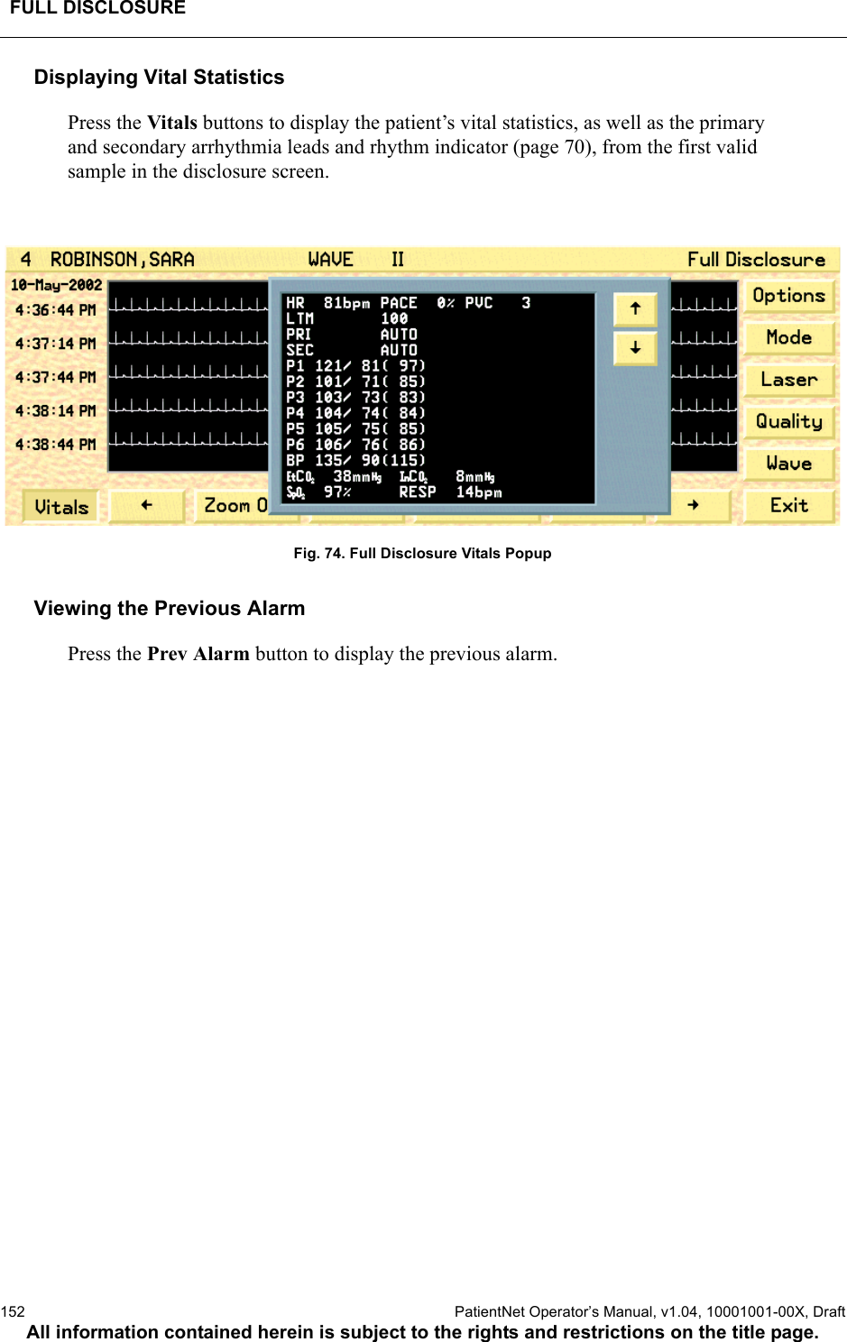 FULL DISCLOSURE152  PatientNet Operator’s Manual, v1.04, 10001001-00X, DraftAll information contained herein is subject to the rights and restrictions on the title page.Displaying Vital StatisticsPress the Vitals buttons to display the patient’s vital statistics, as well as the primary and secondary arrhythmia leads and rhythm indicator (page 70), from the first valid sample in the disclosure screen.Fig. 74. Full Disclosure Vitals PopupViewing the Previous AlarmPress the Prev Alarm button to display the previous alarm.