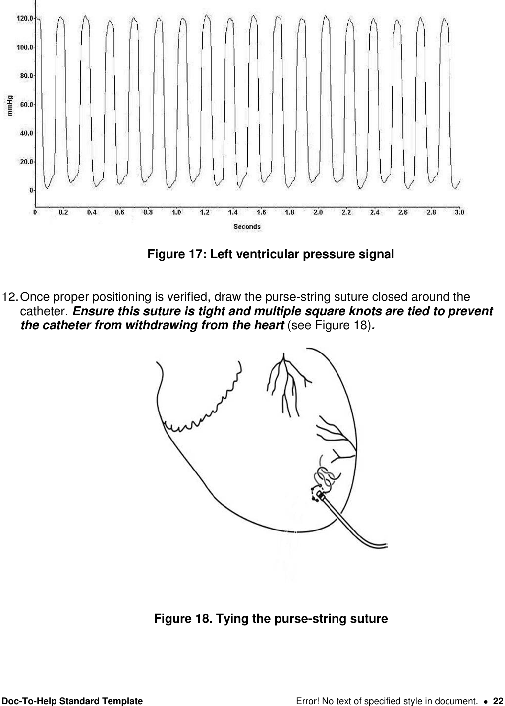 Doc-To-Help Standard Template  Error! No text of specified style in document.    22   Figure 17: Left ventricular pressure signal   12. Once proper positioning is verified, draw the purse-string suture closed around the catheter. Ensure this suture is tight and multiple square knots are tied to prevent the catheter from withdrawing from the heart (see Figure 18).      Figure 18. Tying the purse-string suture    