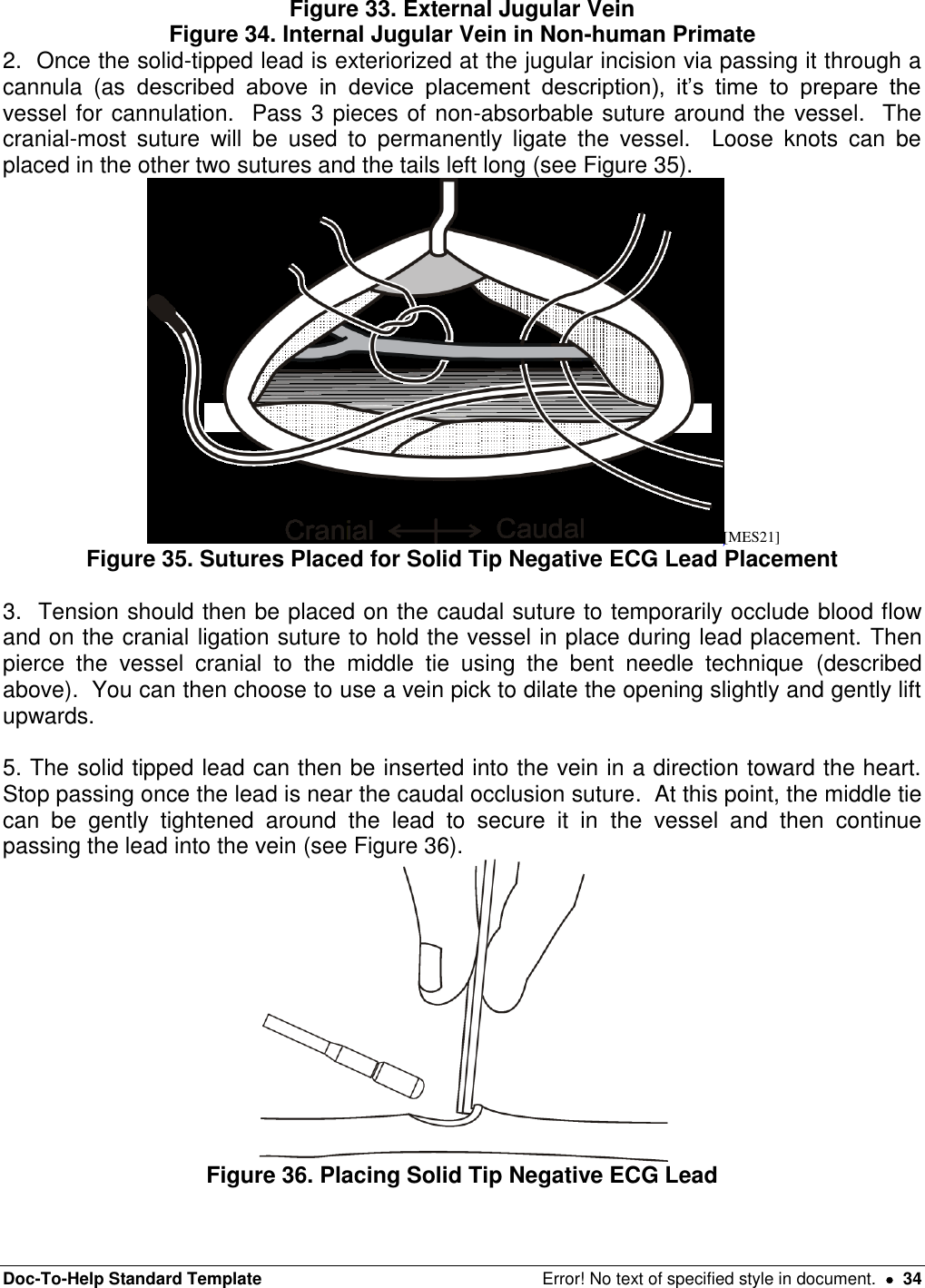 Doc-To-Help Standard Template  Error! No text of specified style in document.    34 Figure 33. External Jugular Vein Figure 34. Internal Jugular Vein in Non-human Primate 2.  Once the solid-tipped lead is exteriorized at the jugular incision via passing it through a cannula  (as  described  above  in  device  placement  description),  it’s  time  to  prepare  the vessel for cannulation.  Pass 3 pieces of non-absorbable suture around the vessel.  The cranial-most  suture  will  be  used  to  permanently  ligate  the  vessel.    Loose  knots  can  be placed in the other two sutures and the tails left long (see Figure 35).   [MES21] Figure 35. Sutures Placed for Solid Tip Negative ECG Lead Placement  3.  Tension should then be placed on the caudal suture to temporarily occlude blood flow and on the cranial ligation suture to hold the vessel in place during lead placement. Then pierce  the  vessel  cranial  to  the  middle  tie  using  the  bent  needle  technique  (described above).  You can then choose to use a vein pick to dilate the opening slightly and gently lift upwards.    5. The solid tipped lead can then be inserted into the vein in a direction toward the heart.  Stop passing once the lead is near the caudal occlusion suture.  At this point, the middle tie can  be  gently  tightened  around  the  lead  to  secure  it  in  the  vessel  and  then  continue passing the lead into the vein (see Figure 36).  Figure 36. Placing Solid Tip Negative ECG Lead  