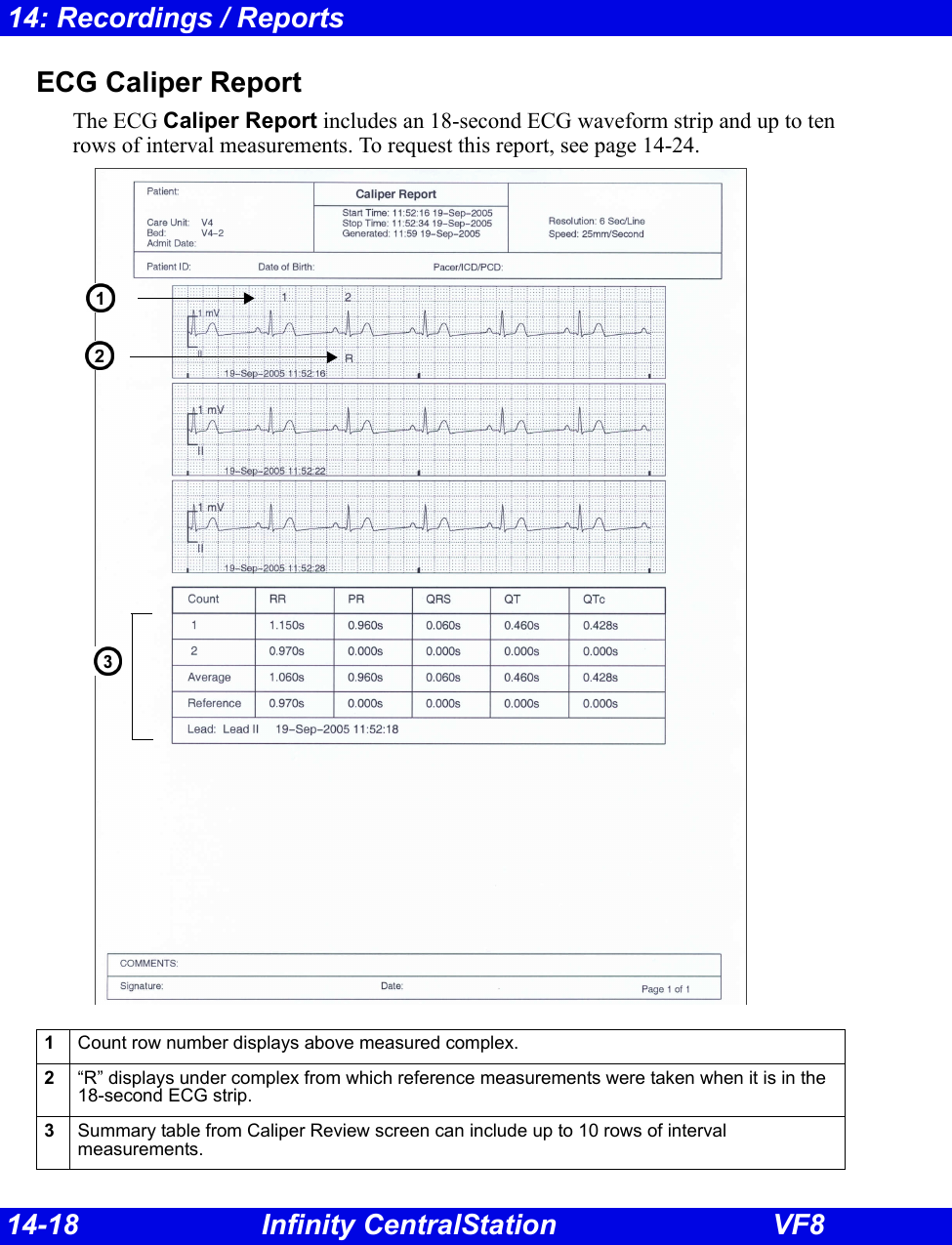 14-18 Infinity CentralStation VF814: Recordings / ReportsECG Caliper ReportThe ECG Caliper Report includes an 18-second ECG waveform strip and up to ten rows of interval measurements. To request this report, see page 14-24.1Count row number displays above measured complex.2“R” displays under complex from which reference measurements were taken when it is in the 18-second ECG strip.3Summary table from Caliper Review screen can include up to 10 rows of interval measurements.