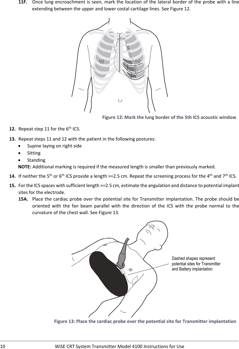 10 WiSECRTSystemTransmitterModel4100InstructionsforUse11F. Oncelungencroachmentisseen,markthelocationofthelateralborderoftheprobewithalineextendingbetweentheupperandlowercostalcartilagelines.SeeFigure12.Figure12:Markthelungborderofthe5thICSacousticwindow12. Repeatstep11forthe6thICS.13. Repeatsteps11and12withthepatientinthefollowingpostures: Supinelayingonrightside Sitting StandingNOTE:Additionalmarkingisrequiredifthemeasuredlengthissmallerthanpreviouslymarked.14. Ifneitherthe5thor6thICSprovidealength&gt;=2.5cm.Repeatthescreeningprocessforthe4thand7thICS.15. FortheICSspaceswithsufficientlength&gt;=2.5cm,estimatetheangulationanddistancetopotentialimplantsitesfortheelectrode.15A. PlacethecardiacprobeoverthepotentialsiteforTransmitterimplantation.Theprobeshouldbeoriented with the fan beam parallel with the direction of the ICS with the probe normal to thecurvatureofthechestwall.SeeFigure13.Figure13:PlacethecardiacprobeoverthepotentialsiteforTransmitterimplantationDashed shapes represent potential sites for Transmitter and Battery implantation 