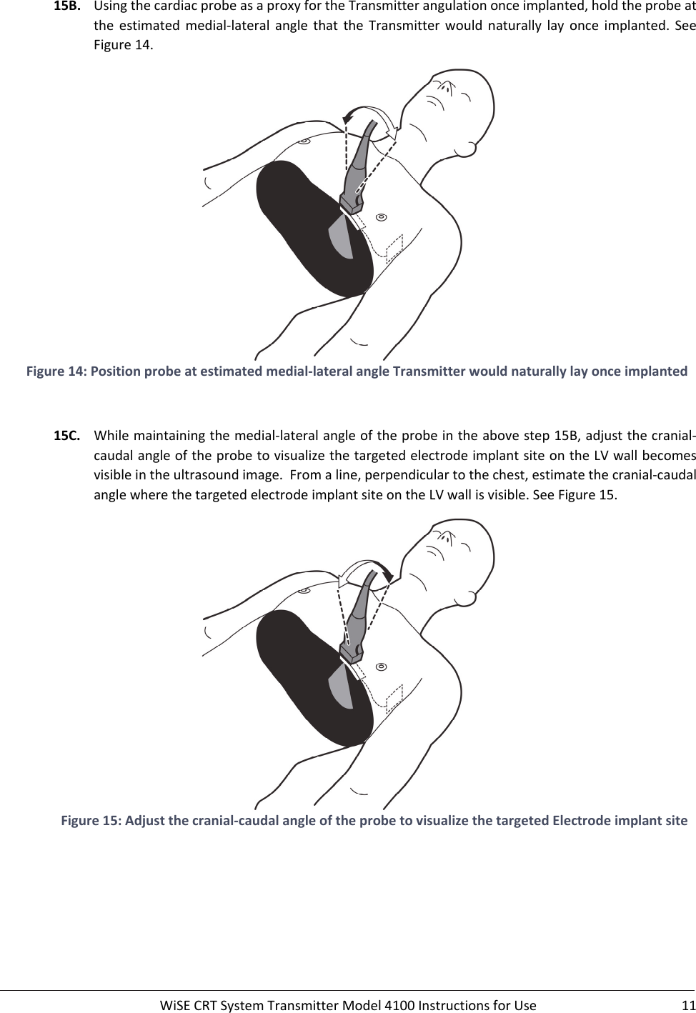  WiSECRTSystemTransmitterModel4100InstructionsforUse 1115B. UsingthecardiacprobeasaproxyfortheTransmitterangulationonceimplanted,holdtheprobeatthe estimated medial‐lateral angle that the Transmitter would naturally lay once implanted.SeeFigure14.Figure14:Positionprobeatestimatedmedial‐lateralangleTransmitterwouldnaturallylayonceimplanted15C. Whilemaintainingthemedial‐lateralangleoftheprobeintheabovestep15B,adjustthecranial‐caudalangleoftheprobetovisualizethetargetedelectrodeimplantsiteontheLVwallbecomesvisibleintheultrasoundimage.Fromaline,perpendiculartothechest,estimatethecranial‐caudalanglewherethetargetedelectrodeimplantsiteontheLVwallisvisible.SeeFigure15.Figure15:Adjustthecranial‐caudalangleoftheprobetovisualizethetargetedElectrodeimplantsite