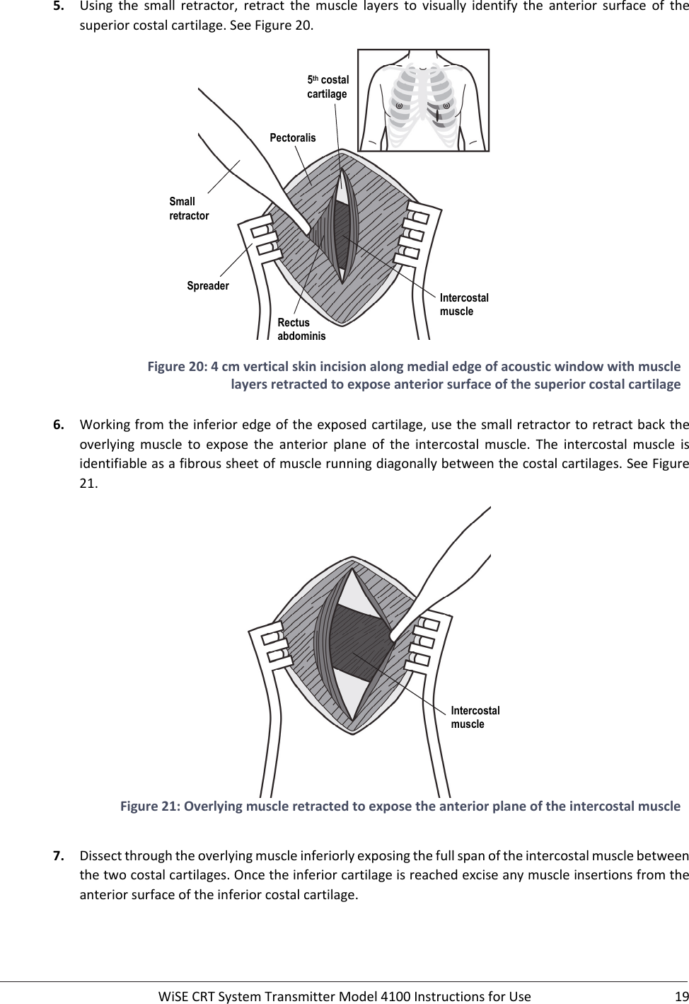  WiSECRTSystemTransmitterModel4100InstructionsforUse 195. Using the small retractor, retractthemusclelayerstovisually identify the anterior surface of thesuperiorcostalcartilage.SeeFigure20.Figure20:4cmverticalskinincisionalongmedialedgeofacousticwindowwithmusclelayersretractedtoexposeanteriorsurfaceofthesuperiorcostalcartilage6. Workingfromtheinferioredgeoftheexposedcartilage,usethesmallretractortoretractbacktheoverlying muscle to expose the anterior plane of the intercostal muscle. The intercostal muscle isidentifiableasafibroussheetofmusclerunningdiagonallybetweenthecostalcartilages.SeeFigure21.Figure21:Overlyingmuscleretractedtoexposetheanteriorplaneoftheintercostalmuscle7. Dissectthroughtheoverlyingmuscleinferiorlyexposingthefullspanoftheintercostalmusclebetweenthetwocostalcartilages.Oncetheinferiorcartilageisreachedexciseanymuscleinsertionsfromtheanteriorsurfaceoftheinferiorcostalcartilage.5th costal  cartilage Pectoralis Rectus abdominis Intercostal muscle Intercostal muscle Small retractor Spreader 