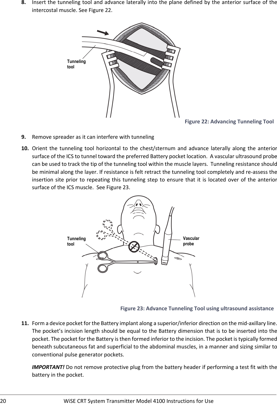 20 WiSECRTSystemTransmitterModel4100InstructionsforUse8. Insertthetunnelingtoolandadvancelaterallyintotheplanedefinedbytheanteriorsurfaceoftheintercostalmuscle.SeeFigure22.Figure22:AdvancingTunnelingTool9. Removespreaderasitcaninterferewithtunneling10. Orient the tunneling tool horizontaltothechest/sternumandadvance laterally along the anteriorsurfaceoftheICStotunneltowardthepreferredBatterypocketlocation.Avascularultrasoundprobecanbeusedtotrackthetipofthetunnelingtoolwithinthemusclelayers.Tunnelingresistanceshouldbeminimalalongthelayer.Ifresistanceisfeltretractthetunnelingtoolcompletelyandre‐assesstheinsertionsiteprior to repeating this tunnelingstep to ensurethatitislocatedover of the anteriorsurfaceoftheICSmuscle.SeeFigure23.Figure23:AdvanceTunnelingToolusingultrasoundassistance11. FormadevicepocketfortheBatteryimplantalongasuperior/inferiordirectiononthemid‐axillaryline.Thepocket’sincisionlengthshouldbeequaltotheBatterydimensionthatistobeinsertedintothepocket.ThepocketfortheBatteryisthenformedinferiortotheincision.Thepocketistypicallyformedbeneathsubcutaneousfatandsuperficialtotheabdominalmuscles,inamannerandsizingsimilartoconventionalpulsegeneratorpockets.IMPORTANT!Donotremoveprotectiveplugfromthebatteryheaderifperformingatestfitwiththebatteryinthepocket.Tunneling tool Tunneling tool Vascular probe 