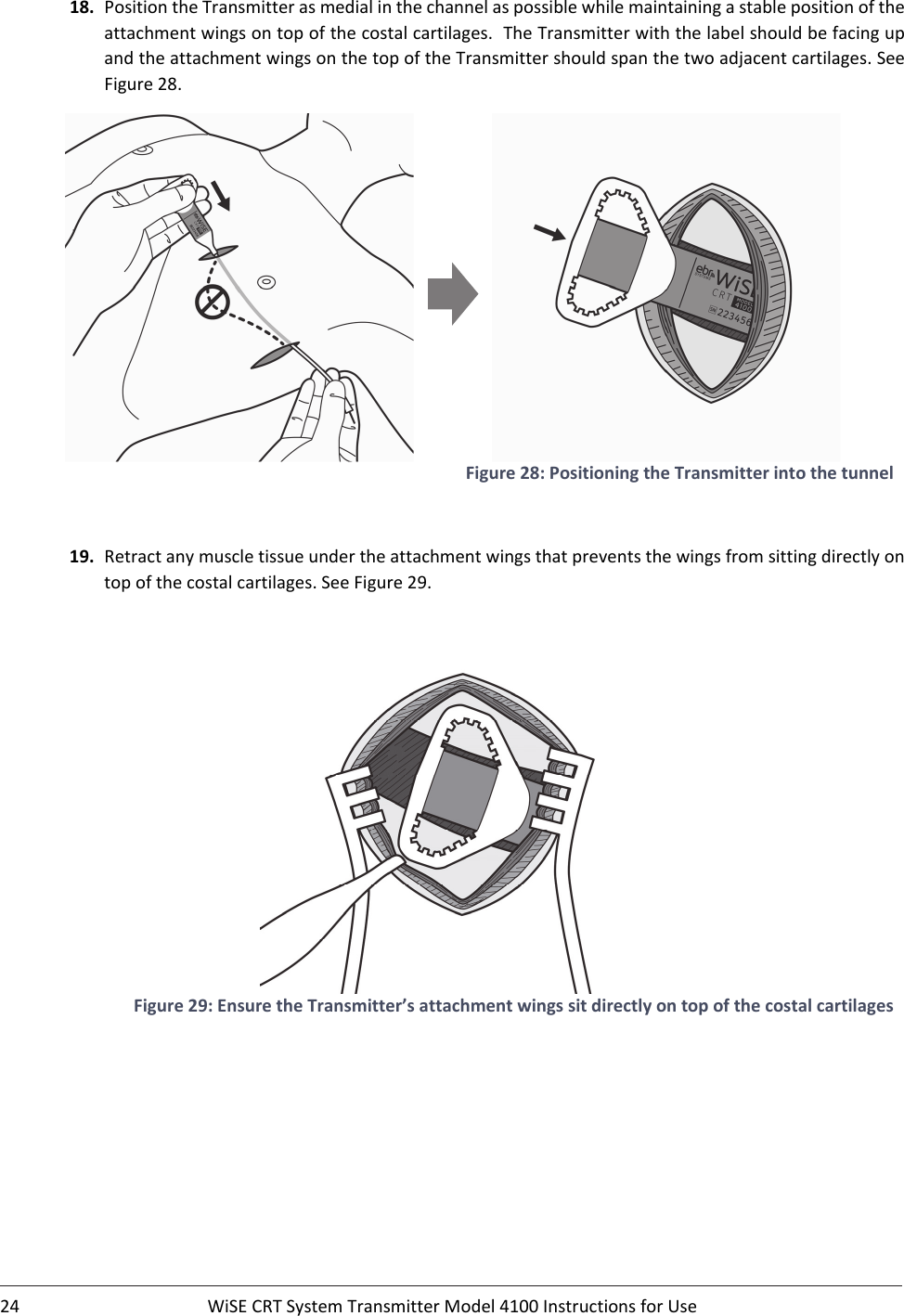 24 WiSECRTSystemTransmitterModel4100InstructionsforUse18. PositiontheTransmitterasmedialinthechannelaspossiblewhilemaintainingastablepositionoftheattachmentwingsontopofthecostalcartilages.TheTransmitterwiththelabelshouldbefacingupandtheattachmentwingsonthetopoftheTransmittershouldspanthetwoadjacentcartilages.SeeFigure28. Figure28:PositioningtheTransmitterintothetunnel19. Retractanymuscletissueundertheattachmentwingsthatpreventsthewingsfromsittingdirectlyontopofthecostalcartilages.SeeFigure29.Figure29:EnsuretheTransmitter’sattachmentwingssitdirectlyontopofthecostalcartilages