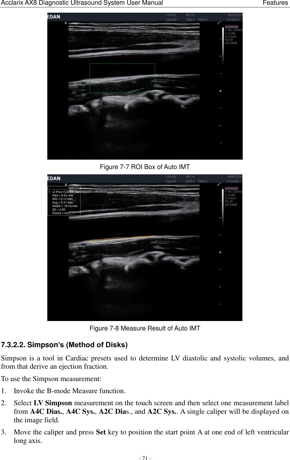 Acclarix AX8 Diagnostic Ultrasound System User Manual                                                              Features - 71 -  Figure 7-7 ROI Box of Auto IMT  Figure 7-8 Measure Result of Auto IMT 7.3.2.2. Simpson’s (Method of Disks) Simpson is a tool in Cardiac presets used to determine LV diastolic and systolic volumes, and from that derive an ejection fraction.   To use the Simpson measurement: 1. Invoke the B-mode Measure function. 2. Select LV Simpson measurement on the touch screen and then select one measurement label from A4C Dias., A4C Sys., A2C Dias., and A2C Sys.. A single caliper will be displayed on the image field.   3. Move the caliper and press Set key to position the start point A at one end of left ventricular long axis. 