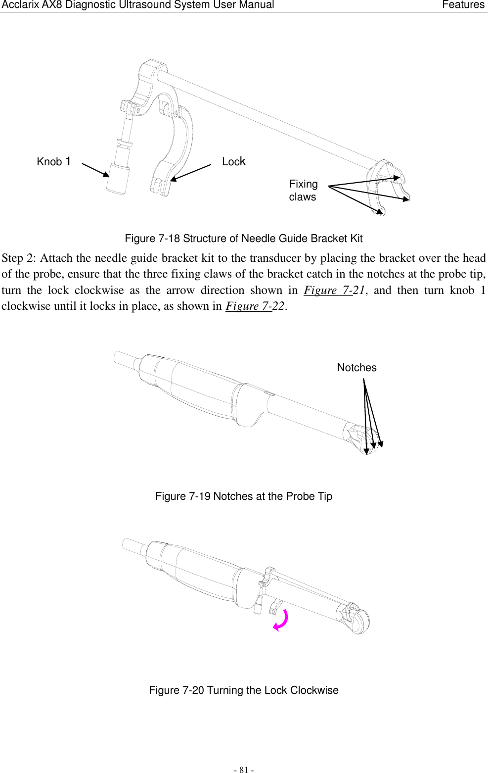Acclarix AX8 Diagnostic Ultrasound System User Manual                                                              Features - 81 -  Figure 7-18 Structure of Needle Guide Bracket Kit   Step 2: Attach the needle guide bracket kit to the transducer by placing the bracket over the head of the probe, ensure that the three fixing claws of the bracket catch in the notches at the probe tip, turn  the  lock  clockwise  as  the  arrow  direction  shown  in  Figure  7-21,  and  then  turn  knob  1 clockwise until it locks in place, as shown in Figure 7-22.  Figure 7-19 Notches at the Probe Tip  Figure 7-20 Turning the Lock Clockwise Lock Knob 1 Fixing claws Notches 