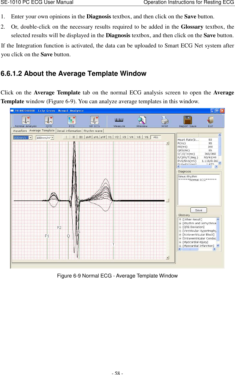 SE-1010 PC ECG User Manual                                                      Operation Instructions for Resting ECG - 58 - 1. Enter your own opinions in the Diagnosis textbox, and then click on the Save button. 2. Or, double-click on the necessary results required to be added in the Glossary textbox, the selected results will be displayed in the Diagnosis textbox, and then click on the Save button. If the Integration function is activated, the data can be uploaded to Smart ECG Net system after you click on the Save button. 6.6.1.2 About the Average Template Window Click on the Average Template tab on the normal  ECG analysis screen  to  open the Average Template window (Figure 6-9). You can analyze average templates in this window.  Figure 6-9 Normal ECG - Average Template Window 