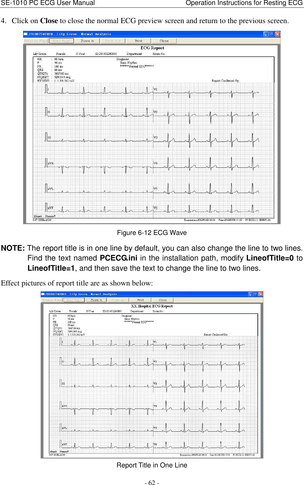 SE-1010 PC ECG User Manual                                                      Operation Instructions for Resting ECG - 62 - 4. Click on Close to close the normal ECG preview screen and return to the previous screen.  Figure 6-12 ECG Wave NOTE: The report title is in one line by default, you can also change the line to two lines. Find the text named PCECG.ini in the installation path, modify LineofTitle=0 to LineofTitle=1, and then save the text to change the line to two lines.   Effect pictures of report title are as shown below:  Report Title in One Line 