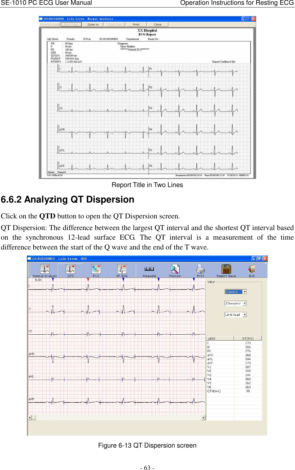 SE-1010 PC ECG User Manual                                                      Operation Instructions for Resting ECG - 63 -  Report Title in Two Lines 6.6.2 Analyzing QT Dispersion Click on the QTD button to open the QT Dispersion screen. QT Dispersion: The difference between the largest QT interval and the shortest QT interval based on  the  synchronous  12-lead  surface  ECG.  The  QT  interval  is  a  measurement  of  the  time difference between the start of the Q wave and the end of the T wave.  Figure 6-13 QT Dispersion screen 