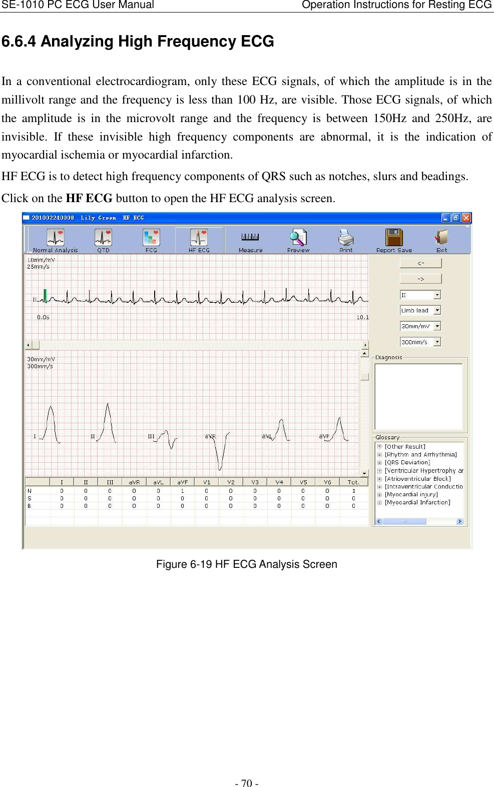 SE-1010 PC ECG User Manual                                                      Operation Instructions for Resting ECG - 70 - 6.6.4 Analyzing High Frequency ECG In a conventional electrocardiogram, only these ECG signals, of which the amplitude is in the millivolt range and the frequency is less than 100 Hz, are visible. Those ECG signals, of which the  amplitude  is  in  the  microvolt  range  and  the  frequency  is  between  150Hz  and  250Hz,  are invisible.  If  these  invisible  high  frequency  components  are  abnormal,  it  is  the  indication  of myocardial ischemia or myocardial infarction. HF ECG is to detect high frequency components of QRS such as notches, slurs and beadings. Click on the HF ECG button to open the HF ECG analysis screen.  Figure 6-19 HF ECG Analysis Screen 