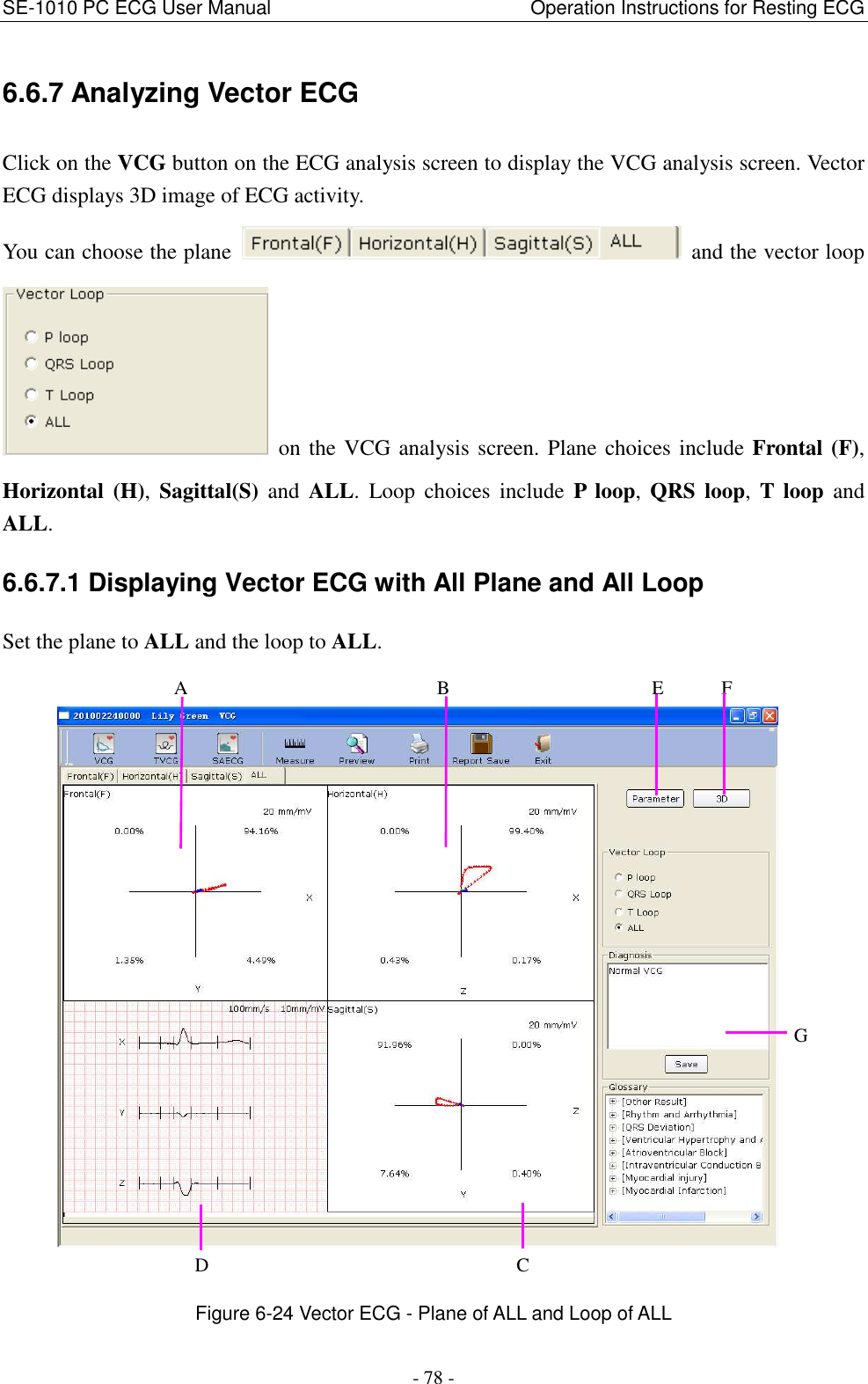 SE-1010 PC ECG User Manual                                                      Operation Instructions for Resting ECG - 78 - 6.6.7 Analyzing Vector ECG Click on the VCG button on the ECG analysis screen to display the VCG analysis screen. Vector ECG displays 3D image of ECG activity. You can choose the plane    and the vector loop   on the VCG analysis screen. Plane choices include Frontal (F), Horizontal  (H),  Sagittal(S)  and  ALL.  Loop  choices  include  P  loop,  QRS  loop,  T  loop  and ALL. 6.6.7.1 Displaying Vector ECG with All Plane and All Loop Set the plane to ALL and the loop to ALL.  Figure 6-24 Vector ECG - Plane of ALL and Loop of ALL             D                                C             A                          B                     E      F G 