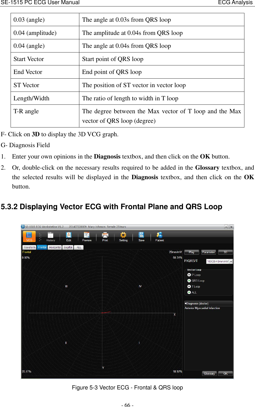 SE-1515 PC ECG User Manual                                                                                                  ECG Analysis - 66 - 0.03 (angle) The angle at 0.03s from QRS loop 0.04 (amplitude) The amplitude at 0.04s from QRS loop 0.04 (angle) The angle at 0.04s from QRS loop Start Vector Start point of QRS loop End Vector End point of QRS loop ST Vector The position of ST vector in vector loop Length/Width The ratio of length to width in T loop T-R angle The degree between the Max vector of T loop and the Max vector of QRS loop (degree) F- Click on 3D to display the 3D VCG graph. G- Diagnosis Field 1. Enter your own opinions in the Diagnosis textbox, and then click on the OK button. 2. Or, double-click on the necessary results required to be added in the Glossary textbox, and the selected results  will be  displayed in  the  Diagnosis  textbox, and then click on the OK button. 5.3.2 Displaying Vector ECG with Frontal Plane and QRS Loop  Figure 5-3 Vector ECG - Frontal &amp; QRS loop 