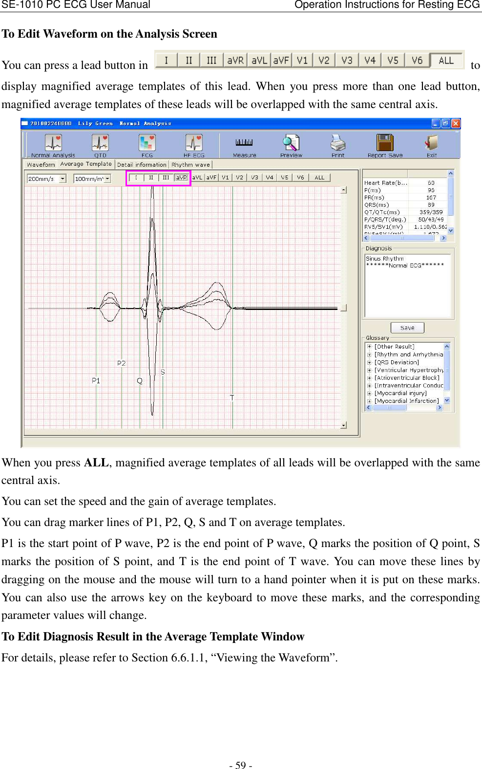 SE-1010 PC ECG User Manual                                                      Operation Instructions for Resting ECG - 59 - To Edit Waveform on the Analysis Screen You can press a lead button in    to display magnified average templates of this lead. When  you press more than one lead button, magnified average templates of these leads will be overlapped with the same central axis.  When you press ALL, magnified average templates of all leads will be overlapped with the same central axis. You can set the speed and the gain of average templates. You can drag marker lines of P1, P2, Q, S and T on average templates. P1 is the start point of P wave, P2 is the end point of P wave, Q marks the position of Q point, S marks the position of S point, and T is the end point of T wave. You can move these lines by dragging on the mouse and the mouse will turn to a hand pointer when it is put on these marks. You can also use the arrows key on the keyboard to move these marks, and the corresponding parameter values will change. To Edit Diagnosis Result in the Average Template Window For details, please refer to Section 6.6.1.1, “Viewing the Waveform”.    