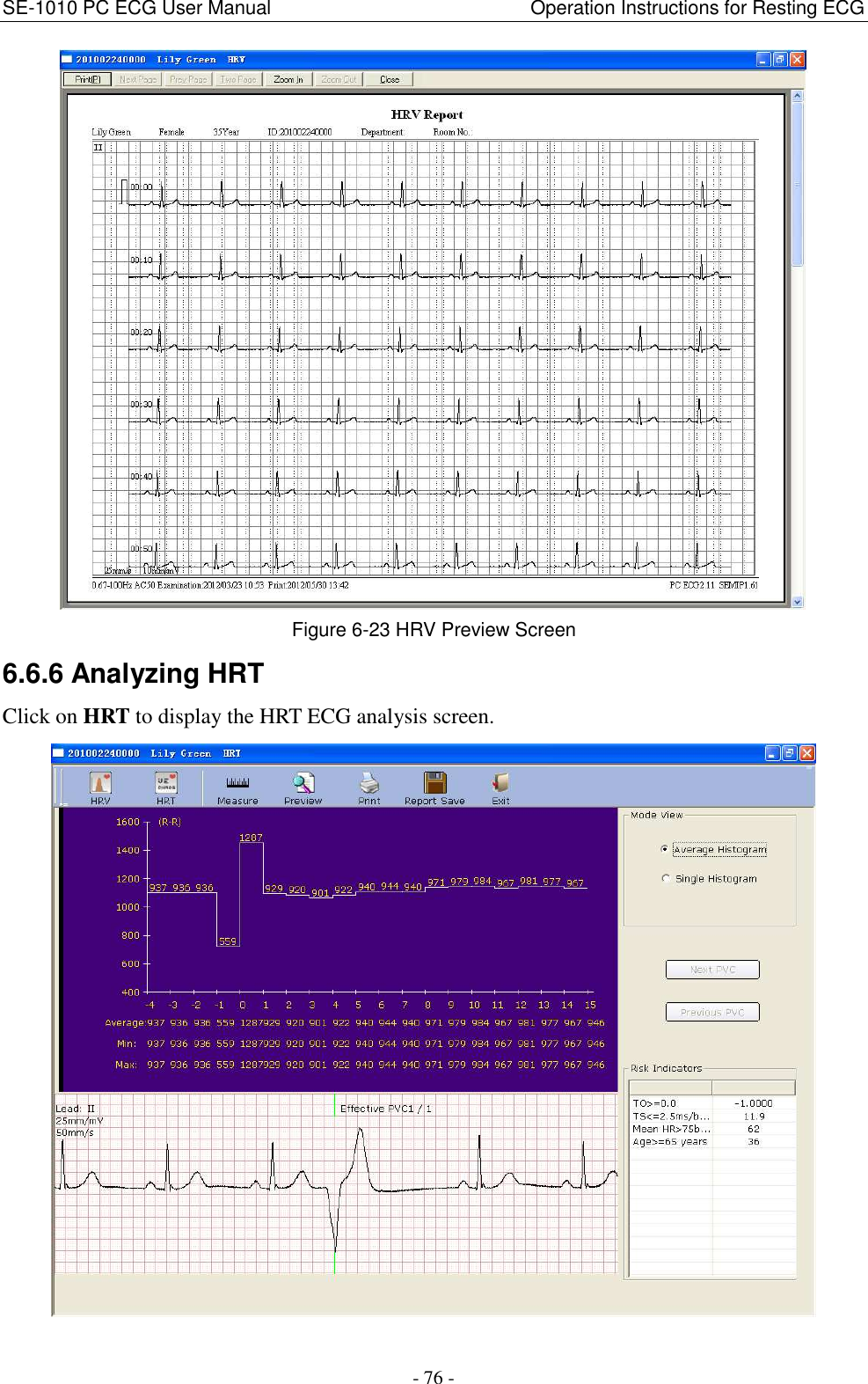 SE-1010 PC ECG User Manual                                                      Operation Instructions for Resting ECG - 76 -  Figure 6-23 HRV Preview Screen 6.6.6 Analyzing HRT Click on HRT to display the HRT ECG analysis screen.    