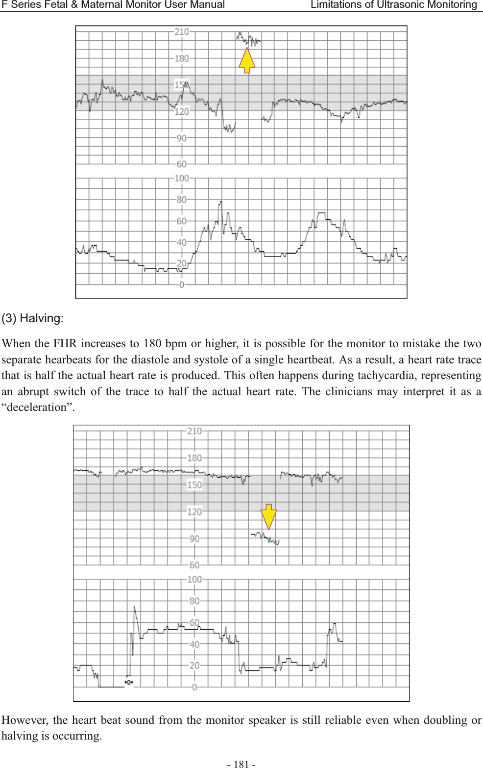 F Series Fetal &amp; Maternal Monitor User Manual                                Limitations of Ultrasonic Monitoring - 181 -  (3) Halving: When the FHR increases to 180 bpm or higher, it is possible for the monitor to mistake the two separate hearbeats for the diastole and systole of a single heartbeat. As a result, a heart rate trace that is half the actual heart rate is produced. This often happens during tachycardia, representing an abrupt switch of the trace to half the actual heart rate. The clinicians may interpret it as a “deceleration”.  However, the heart beat sound from the monitor speaker is still reliable even when doubling or halving is occurring. 