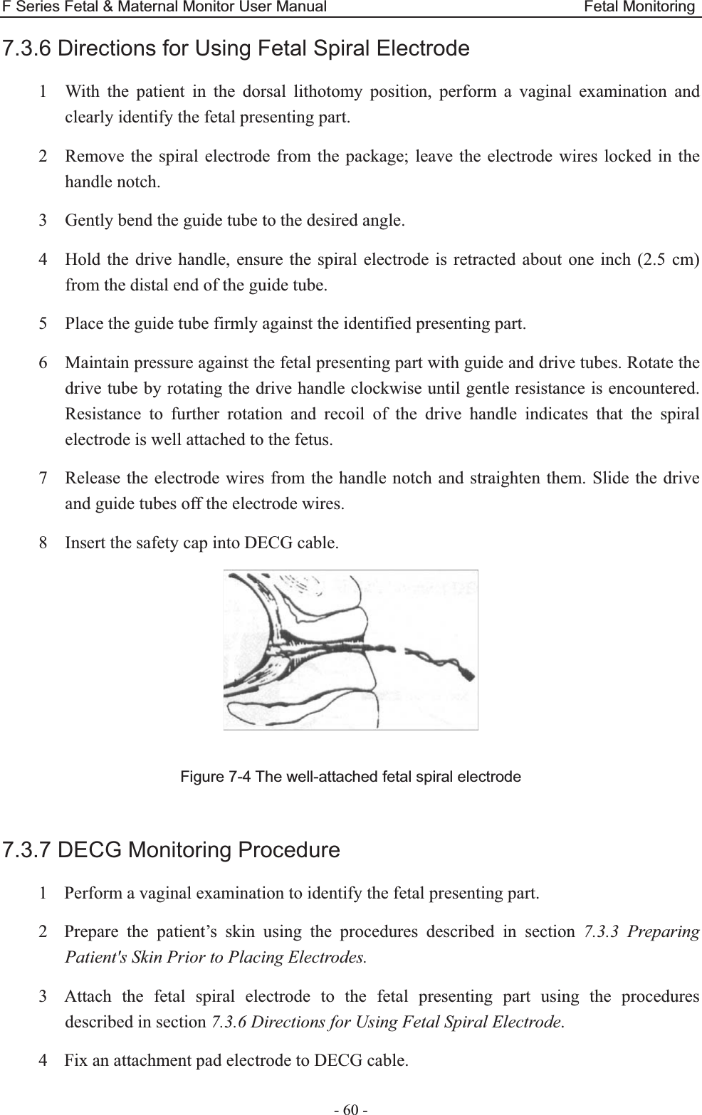 F Series Fetal &amp; Maternal Monitor User Manual                                 Fetal Monitoring - 60 - 7.3.6 Directions for Using Fetal Spiral Electrode 1 With the patient in the dorsal lithotomy position, perform a vaginal examination and clearly identify the fetal presenting part. 2 Remove the spiral electrode from the package; leave the electrode wires locked in the handle notch. 3 Gently bend the guide tube to the desired angle. 4 Hold the drive handle, ensure the spiral electrode is retracted about one inch (2.5 cm) from the distal end of the guide tube. 5 Place the guide tube firmly against the identified presenting part. 6 Maintain pressure against the fetal presenting part with guide and drive tubes. Rotate the drive tube by rotating the drive handle clockwise until gentle resistance is encountered. Resistance to further rotation and recoil of the drive handle indicates that the spiral electrode is well attached to the fetus. 7 Release the electrode wires from the handle notch and straighten them. Slide the drive and guide tubes off the electrode wires. 8 Insert the safety cap into DECG cable.   Figure 7-4 The well-attached fetal spiral electrode  7.3.7 DECG Monitoring Procedure 1 Perform a vaginal examination to identify the fetal presenting part. 2 Prepare the patient’s skin using the procedures described in section 7.3.3 Preparing Patient&apos;s Skin Prior to Placing Electrodes. 3 Attach the fetal spiral electrode to the fetal presenting part using the procedures described in section 7.3.6 Directions for Using Fetal Spiral Electrode. 4 Fix an attachment pad electrode to DECG cable. 