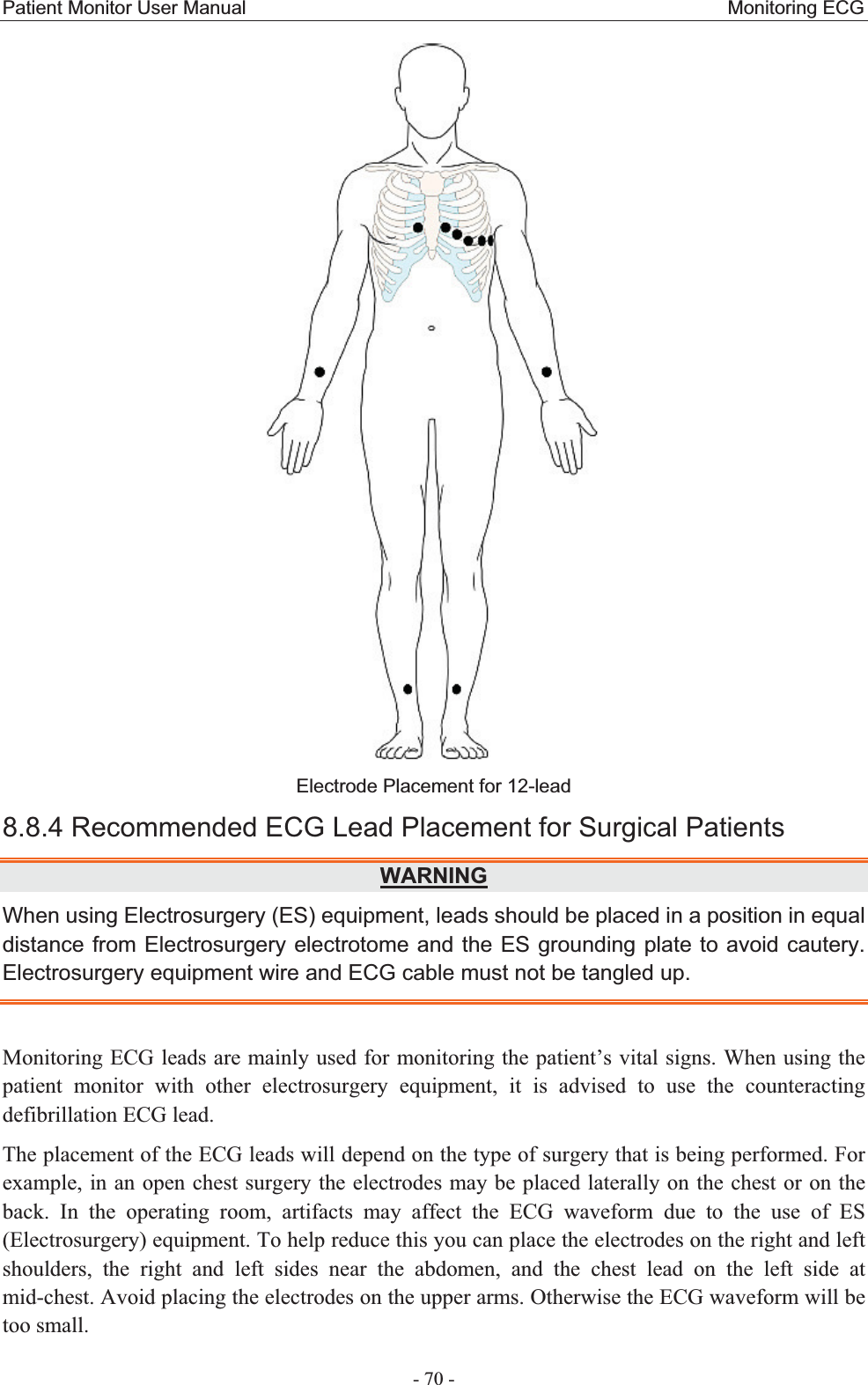 Patient Monitor User Manual                                                  Monitoring ECG  - 70 - Electrode Placement for 12-lead   8.8.4 Recommended ECG Lead Placement for Surgical PatientsWARNINGWhen using Electrosurgery (ES) equipment, leads should be placed in a position in equal distance from Electrosurgery electrotome and the ES grounding plate to avoid cautery. Electrosurgery equipment wire and ECG cable must not be tangled up. Monitoring ECG leads are mainly used for monitoring the patient’s vital signs. When using the patient monitor with other electrosurgery equipment, it is advised to use the counteracting defibrillation ECG lead. The placement of the ECG leads will depend on the type of surgery that is being performed. For example, in an open chest surgery the electrodes may be placed laterally on the chest or on the back. In the operating room, artifacts may affect the ECG waveform due to the use of ES (Electrosurgery) equipment. To help reduce this you can place the electrodes on the right and leftshoulders, the right and left sides near the abdomen, and the chest lead on the left side at mid-chest. Avoid placing the electrodes on the upper arms. Otherwise the ECG waveform will be too small. 