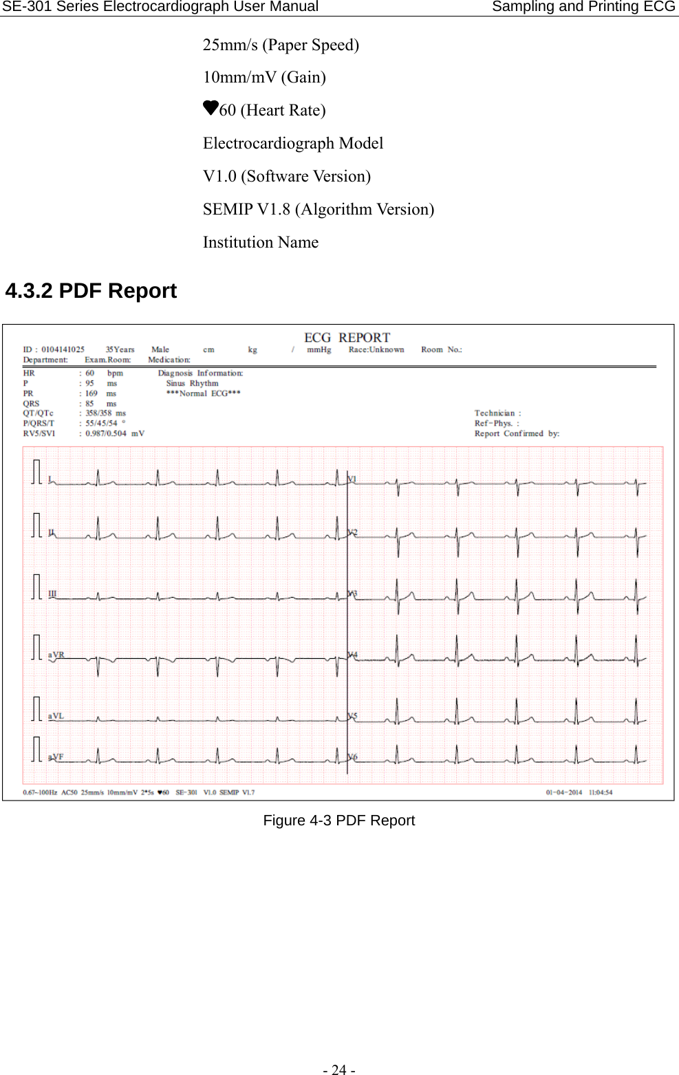 SE-301 Series Electrocardiograph User Manual                       Sampling and Printing ECG - 24 - 25mm/s (Paper Speed) 10mm/mV (Gain) 60 (Heart Rate) Electrocardiograph Model V1.0 (Software Version) SEMIP V1.8 (Algorithm Version) Institution Name 4.3.2 PDF Report  Figure 4-3 PDF Report  