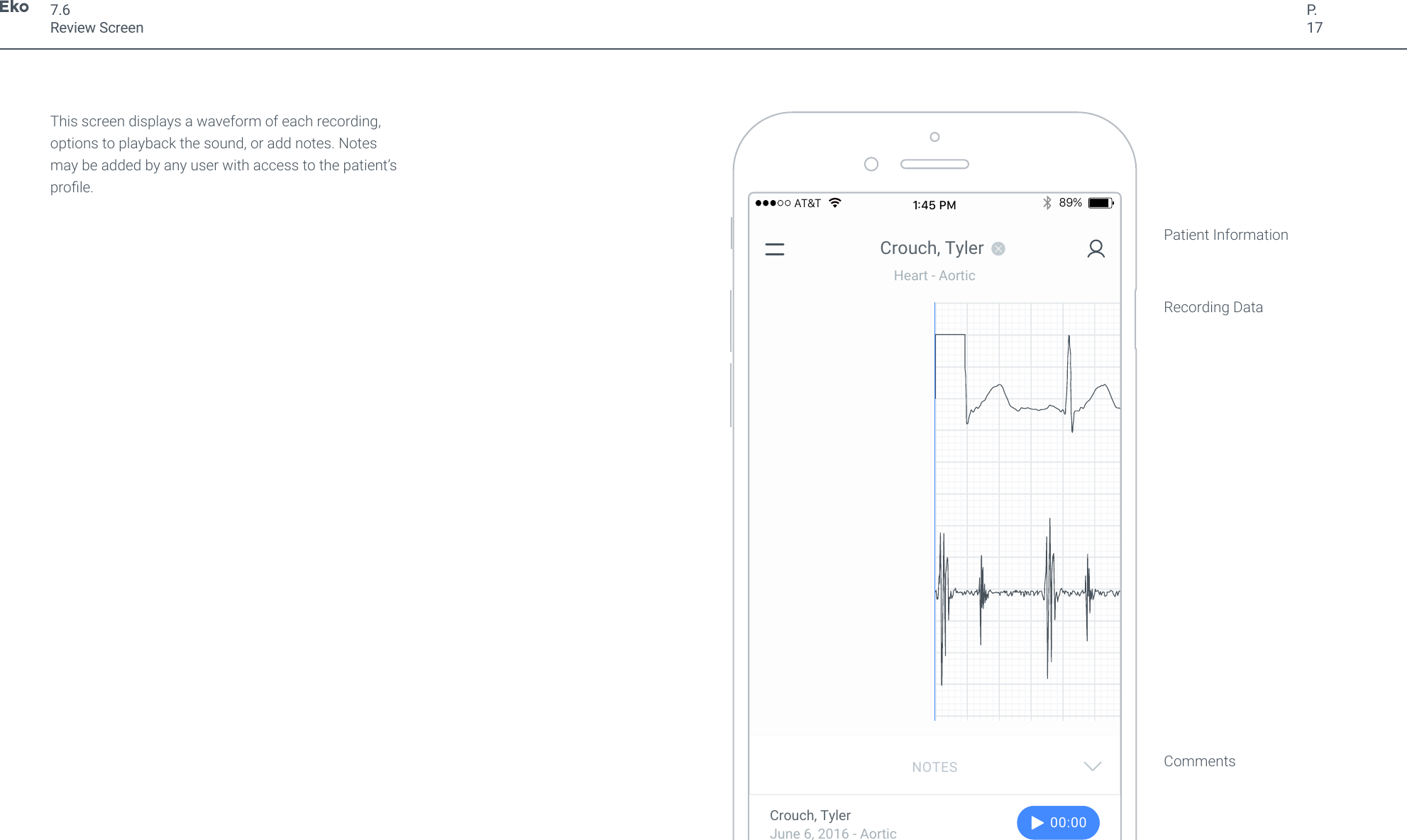 P.17This screen displays a waveform of each recording, options to playback the sound, or add notes. Notes may be added by any user with access to the patient&rsquo;s prole. 7.6Review ScreenCan someone take a closer look at 01:57 for me?Martin Stemper 4:59pmRRR Murmur heard and Indicated.Martin Stemper 4:59pmThis is one of the more complicated ab cardiology characteristics.  Will address tomorrow.You 4:59pmNOTESAdd Note&hellip;Crouch, Tyler89%AT&amp;T1:45 PMHeart - AorticThanksMartin Stemper 5:05pmJune 6, 2016 - AorticCrouch, Tyler00:0000:00CommentsPatient InformationRecording DataJune 6, 2016 - AorticCrouch, Tyler 00:0000:00