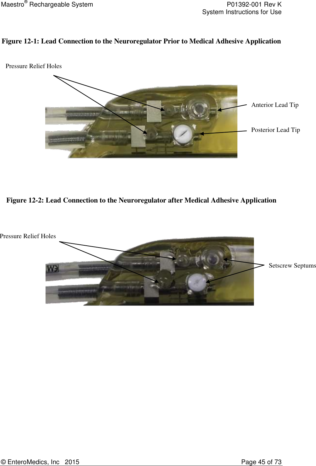 Maestro® Rechargeable System    P01392-001 Rev K     System Instructions for Use  © EnteroMedics, Inc   2015  Page 45 of 73  Pressure Relief Holes Setscrew Septums Anterior Lead Tip Pressure Relief Holes Posterior Lead Tip  Figure 12-1: Lead Connection to the Neuroregulator Prior to Medical Adhesive Application      Figure 12-2: Lead Connection to the Neuroregulator after Medical Adhesive Application   