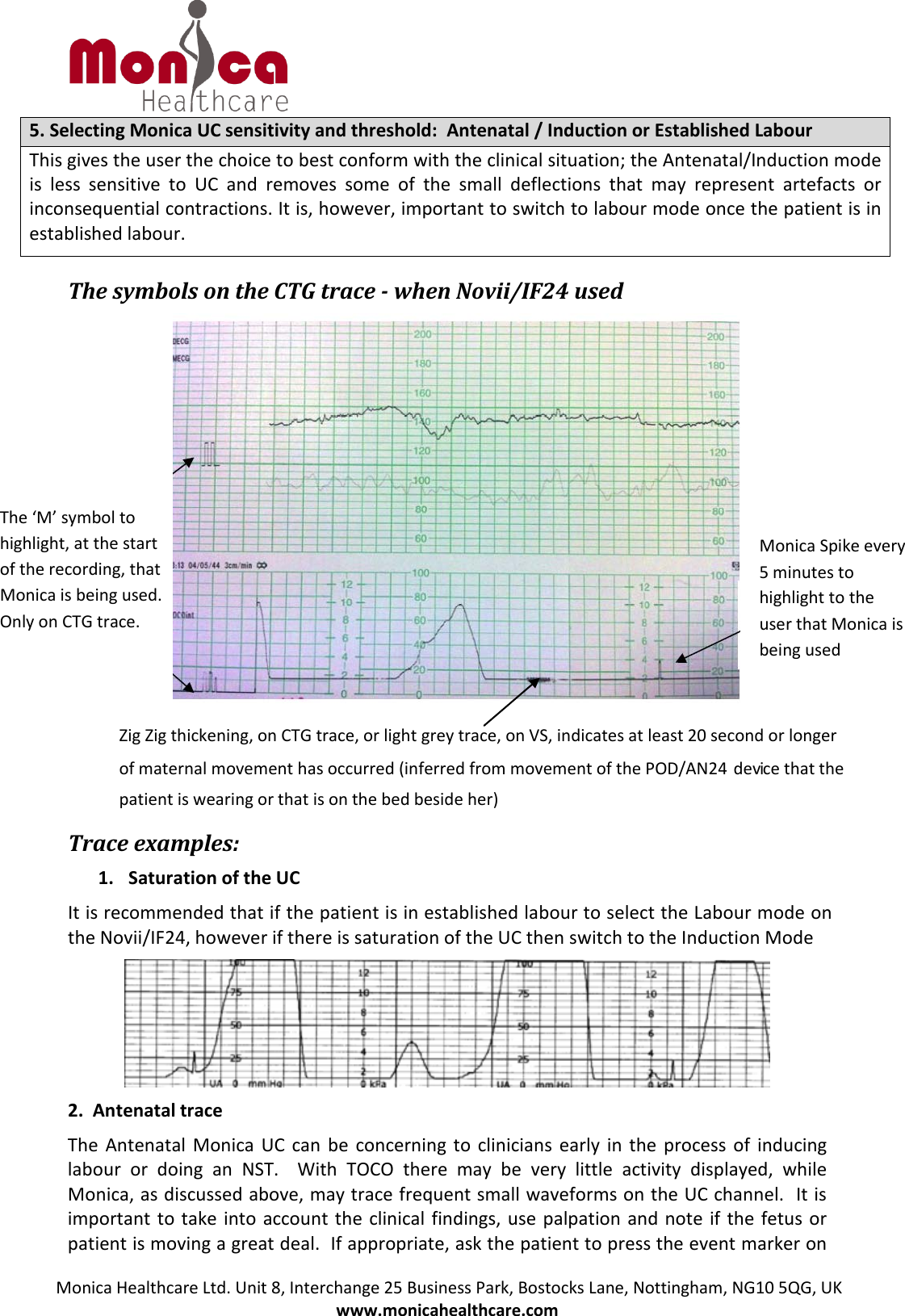 Monica Healthcare Ltd. Unit 8, Interchange 25 Business Park, Bostocks Lane, Nottingham, NG10 5QG, UK www.monicahealthcare.com 5. Selecting Monica UC sensitivity and threshold:  Antenatal / Induction or Established LabourThis gives the user the choice to best conform with the clinical situation; the Antenatal/Induction mode is less sensitive to UC and removes some of the small deflections that may represent artefacts or inconsequential contractions. It is, however, important to switch to labour mode once the patient is in established labour.  The symbols on the CTG trace - when Novii/IF24 used    Trace examples: 1. Saturation of the UCIt is recommended that if the patient is in established labour to select the Labour mode on the Novii/IF24, however if there is saturation of the UC then switch to the Induction Mode  2. Antenatal traceThe Antenatal Monica UC can be concerning to clinicians early in the process of inducing labour or doing an NST.  With TOCO there may be very little activity displayed, while Monica, as discussed above, may trace frequent small waveforms on the UC channel.  It is important to take into account the clinical findings, use palpation and note if the fetus or patient is moving a great deal.  If appropriate, ask the patient to press the event marker on Monica Spike every 5 minutes to highlight to the user that Monica is being used The ‘M’ symbol to highlight, at the start of the recording, that Monica is being used. Only on CTG trace. Zig Zig thickening, on CTG trace, or light grey trace, on VS, indicates at least 20 second or longer of maternal movement has occurred (inferred from movement of the POD/AN24   dev i    ce that the patient is wearing or that is on the bed beside her) 