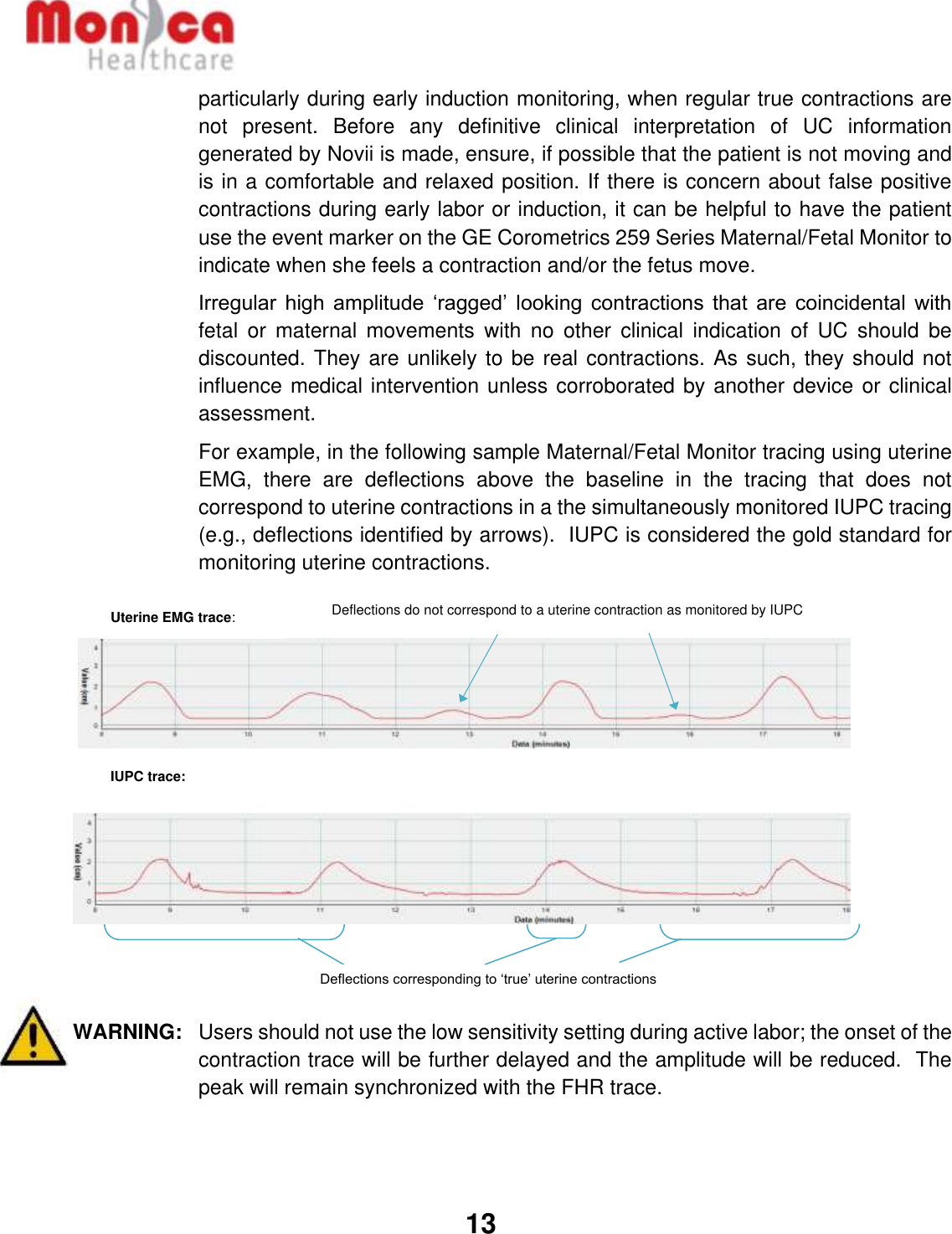   13  particularly during early induction monitoring, when regular true contractions are not  present.  Before  any  definitive  clinical  interpretation  of  UC  information generated by Novii is made, ensure, if possible that the patient is not moving and is in a comfortable and relaxed position. If there is concern about false positive contractions during early labor or induction, it can be helpful to have the patient use the event marker on the GE Corometrics 259 Series Maternal/Fetal Monitor to indicate when she feels a contraction and/or the fetus move. Irregular  high  amplitude  ‘ragged’  looking contractions  that  are  coincidental with fetal  or  maternal  movements  with  no  other  clinical  indication  of  UC  should  be discounted. They are unlikely to be real contractions. As such, they should not influence medical intervention unless corroborated by another device or clinical assessment. For example, in the following sample Maternal/Fetal Monitor tracing using uterine EMG,  there  are  deflections  above  the  baseline  in  the  tracing  that  does  not correspond to uterine contractions in a the simultaneously monitored IUPC tracing (e.g., deflections identified by arrows).  IUPC is considered the gold standard for monitoring uterine contractions.  WARNING:   Users should not use the low sensitivity setting during active labor; the onset of the contraction trace will be further delayed and the amplitude will be reduced.  The peak will remain synchronized with the FHR trace.   Deflections do not correspond to a uterine contraction as monitored by IUPC      Deflections corresponding to ‘true’ uterine contractions Uterine EMG trace: IUPC trace: 