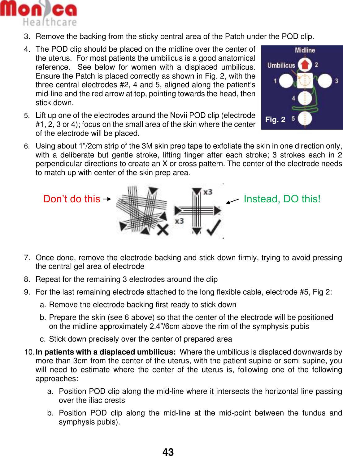   43  3.  Remove the backing from the sticky central area of the Patch under the POD clip. 4.  The POD clip should be placed on the midline over the center of the uterus.  For most patients the umbilicus is a good anatomical reference.    See  below  for  women  with  a  displaced  umbilicus.  Ensure the Patch is placed correctly as shown in Fig. 2, with the three central electrodes #2, 4 and 5, aligned along the patient’s mid-line and the red arrow at top, pointing towards the head, then stick down. 5. Lift up one of the electrodes around the Novii POD clip (electrode #1, 2, 3 or 4); focus on the small area of the skin where the center of the electrode will be placed. 6. Using about 1”/2cm strip of the 3M skin prep tape to exfoliate the skin in one direction only, with a  deliberate  but  gentle stroke, lifting  finger  after each  stroke;  3  strokes each  in  2 perpendicular directions to create an X or cross pattern. The center of the electrode needs to match up with center of the skin prep area.       7.  Once done, remove the electrode backing and stick down firmly, trying to avoid pressing the central gel area of electrode 8.  Repeat for the remaining 3 electrodes around the clip 9.  For the last remaining electrode attached to the long flexible cable, electrode #5, Fig 2: a. Remove the electrode backing first ready to stick down  b. Prepare the skin (see 6 above) so that the center of the electrode will be positioned on the midline approximately 2.4”/6cm above the rim of the symphysis pubis c. Stick down precisely over the center of prepared area 10. In patients with a displaced umbilicus:  Where the umbilicus is displaced downwards by more than 3cm from the center of the uterus, with the patient supine or semi supine, you will  need  to  estimate  where  the  center  of  the  uterus  is,  following  one  of  the  following approaches: a.  Position POD clip along the mid-line where it intersects the horizontal line passing over the iliac crests  b.  Position  POD  clip  along  the  mid-line  at  the  mid-point  between  the  fundus  and symphysis pubis).  Don’t do this  Instead, DO this! Fig. 2 
