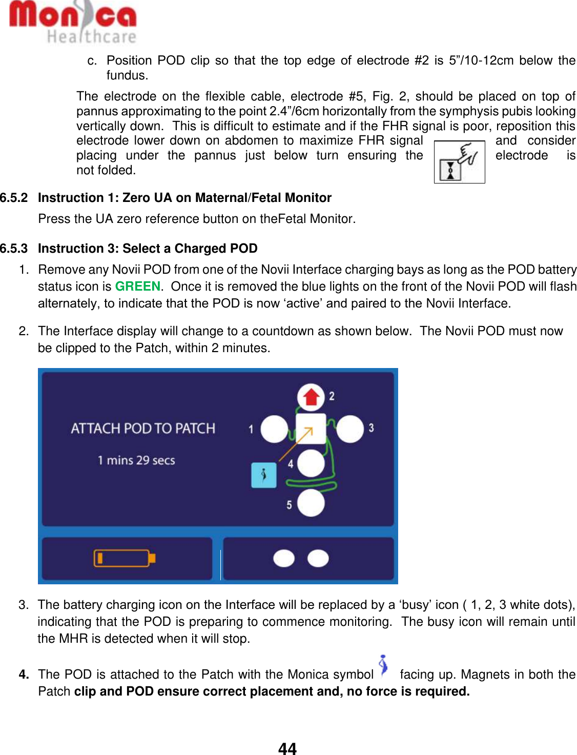   44  c.  Position  POD  clip  so that the top  edge  of  electrode #2 is  5”/10-12cm below the fundus. The  electrode on  the  flexible  cable,  electrode #5,  Fig.  2,  should be  placed  on  top  of pannus approximating to the point 2.4”/6cm horizontally from the symphysis pubis looking vertically down.  This is difficult to estimate and if the FHR signal is poor, reposition this electrode lower down on abdomen to maximize FHR signal  and  consider placing  under  the  pannus  just  below  turn  ensuring  the  electrode  is not folded. 6.5.2  Instruction 1: Zero UA on Maternal/Fetal Monitor Press the UA zero reference button on theFetal Monitor.  6.5.3  Instruction 3: Select a Charged POD 1.  Remove any Novii POD from one of the Novii Interface charging bays as long as the POD battery status icon is GREEN.  Once it is removed the blue lights on the front of the Novii POD will flash alternately, to indicate that the POD is now ‘active’ and paired to the Novii Interface. 2. The Interface display will change to a countdown as shown below.  The Novii POD must now be clipped to the Patch, within 2 minutes.   3. The battery charging icon on the Interface will be replaced by a ‘busy’ icon ( 1, 2, 3 white dots), indicating that the POD is preparing to commence monitoring.  The busy icon will remain until the MHR is detected when it will stop. 4. The POD is attached to the Patch with the Monica symbol     facing up. Magnets in both the Patch clip and POD ensure correct placement and, no force is required.   