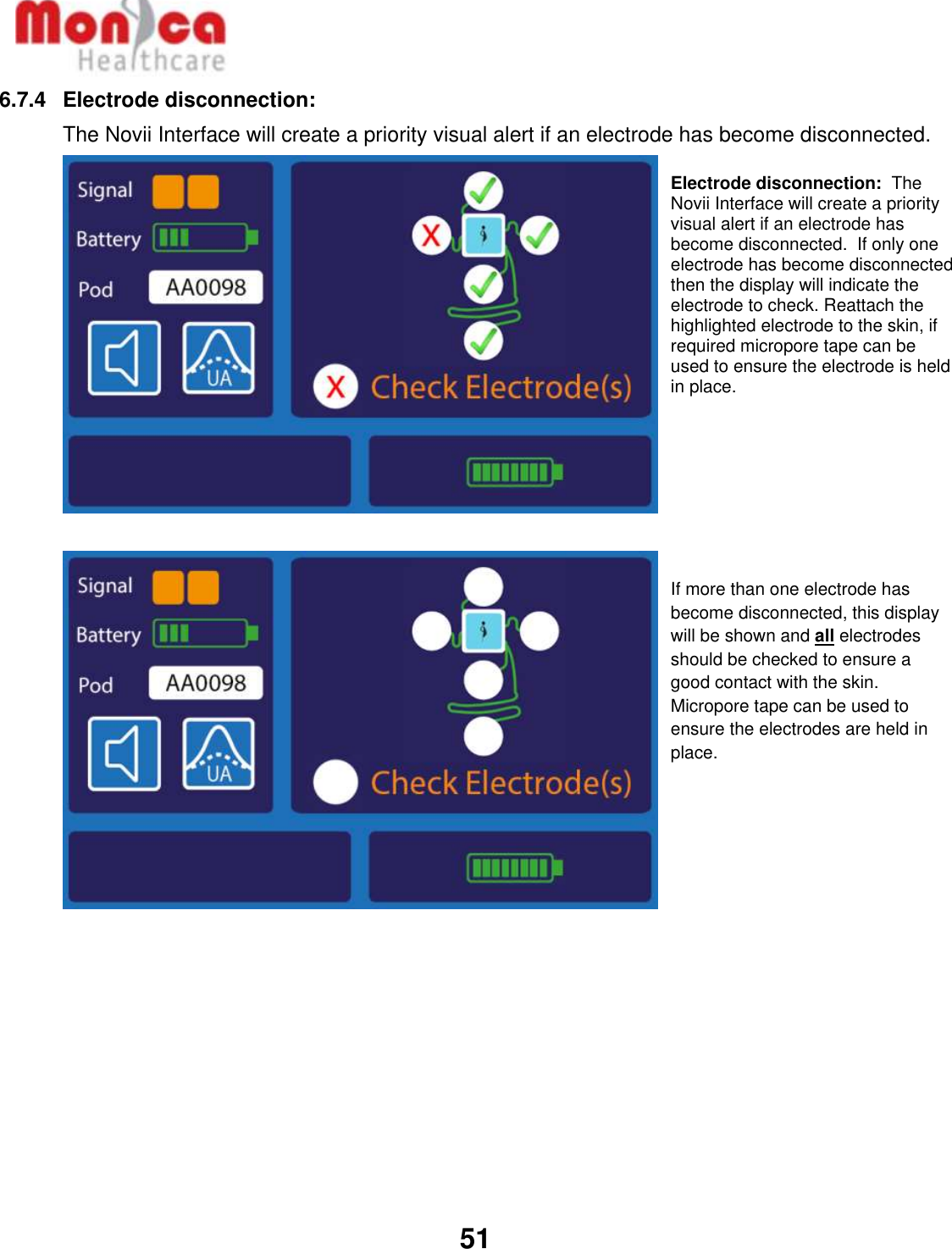   51  6.7.4  Electrode disconnection:   The Novii Interface will create a priority visual alert if an electrode has become disconnected.                        Electrode disconnection:  The Novii Interface will create a priority visual alert if an electrode has become disconnected.  If only one electrode has become disconnected then the display will indicate the electrode to check. Reattach the highlighted electrode to the skin, if required micropore tape can be used to ensure the electrode is held in place.          If more than one electrode has become disconnected, this display will be shown and all electrodes should be checked to ensure a good contact with the skin. Micropore tape can be used to ensure the electrodes are held in place. 