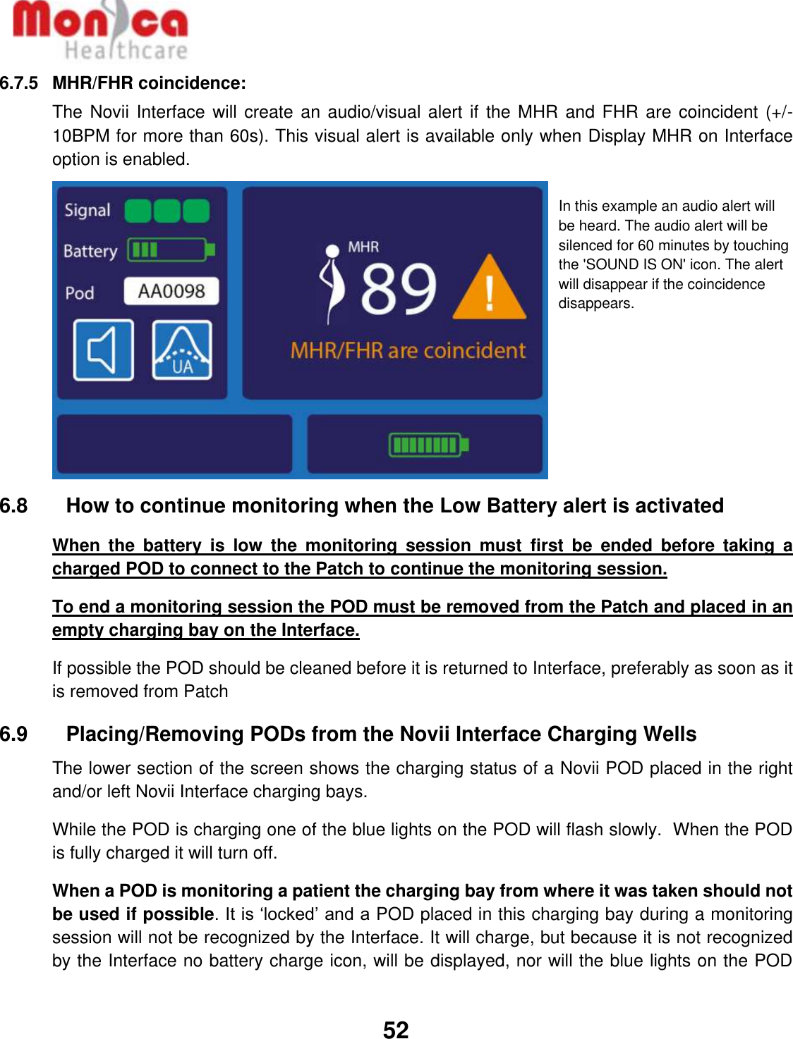   52  6.7.5  MHR/FHR coincidence:  The Novii Interface  will create an audio/visual alert if the MHR  and FHR are coincident  (+/-10BPM for more than 60s). This visual alert is available only when Display MHR on Interface option is enabled.         6.8    How to continue monitoring when the Low Battery alert is activated When  the  battery  is  low  the  monitoring  session  must  first  be  ended  before  taking  a charged POD to connect to the Patch to continue the monitoring session. To end a monitoring session the POD must be removed from the Patch and placed in an empty charging bay on the Interface. If possible the POD should be cleaned before it is returned to Interface, preferably as soon as it is removed from Patch 6.9    Placing/Removing PODs from the Novii Interface Charging Wells The lower section of the screen shows the charging status of a Novii POD placed in the right and/or left Novii Interface charging bays.  While the POD is charging one of the blue lights on the POD will flash slowly.  When the POD is fully charged it will turn off. When a POD is monitoring a patient the charging bay from where it was taken should not be used if possible. It is ‘locked’ and a POD placed in this charging bay during a monitoring session will not be recognized by the Interface. It will charge, but because it is not recognized by the Interface no battery charge icon, will be displayed, nor will the blue lights on the POD In this example an audio alert will be heard. The audio alert will be silenced for 60 minutes by touching the &apos;SOUND IS ON&apos; icon. The alert will disappear if the coincidence disappears.  