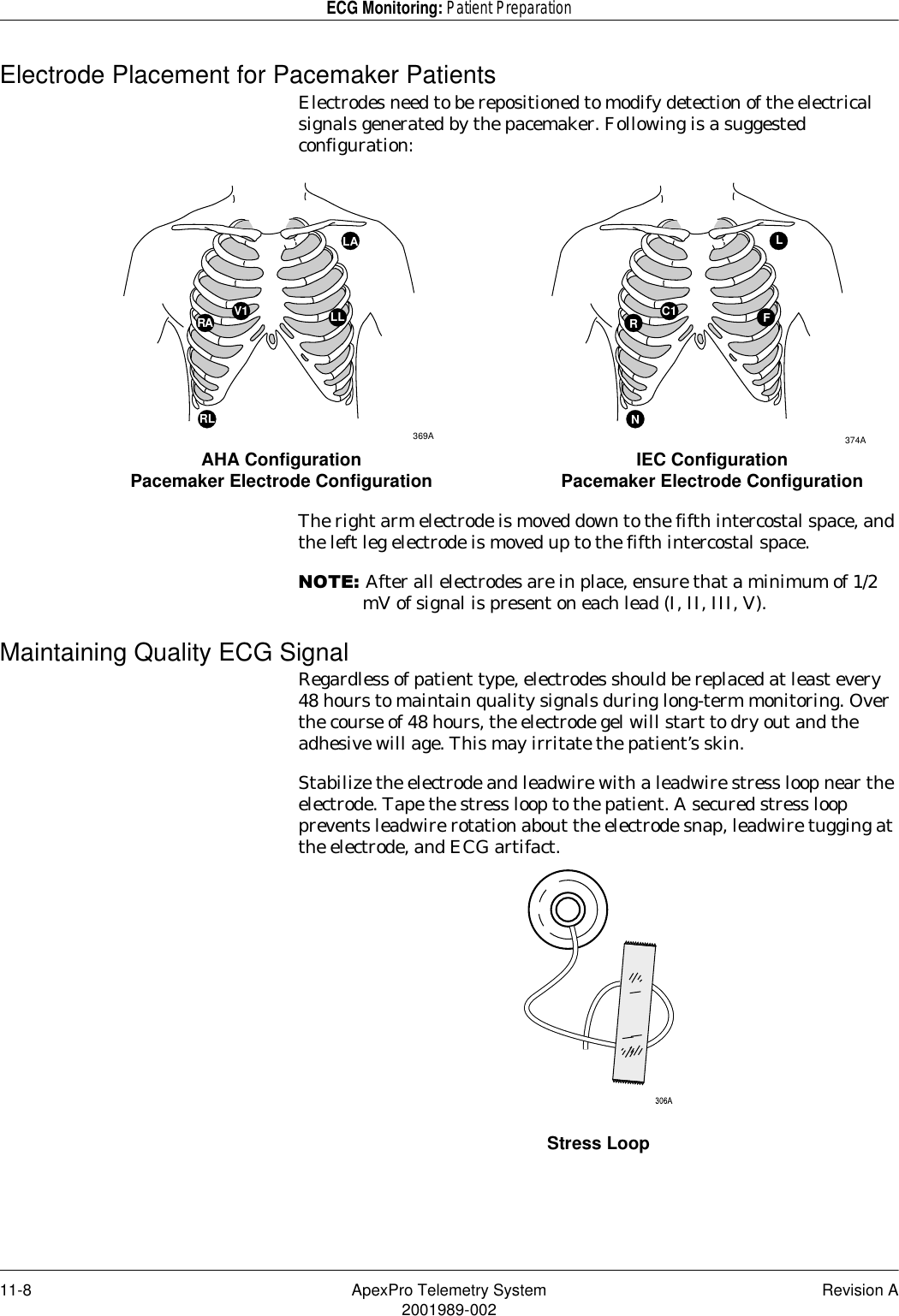 11-8 ApexPro Telemetry System Revision A2001989-002ECG Monitoring: Patient PreparationElectrode Placement for Pacemaker PatientsElectrodes need to be repositioned to modify detection of the electrical signals generated by the pacemaker. Following is a suggested configuration:The right arm electrode is moved down to the fifth intercostal space, and the left leg electrode is moved up to the fifth intercostal space.127(After all electrodes are in place, ensure that a minimum of 1/2 mV of signal is present on each lead (I, II, III, V).Maintaining Quality ECG SignalRegardless of patient type, electrodes should be replaced at least every 48 hours to maintain quality signals during long-term monitoring. Over the course of 48 hours, the electrode gel will start to dry out and the adhesive will age. This may irritate the patient’s skin.Stabilize the electrode and leadwire with a leadwire stress loop near the electrode. Tape the stress loop to the patient. A secured stress loop prevents leadwire rotation about the electrode snap, leadwire tugging at the electrode, and ECG artifact.Stress LoopLC1RFN374ARALAV1 LL RL369AAHA ConfigurationPacemaker Electrode Configuration IEC ConfigurationPacemaker Electrode Configuration